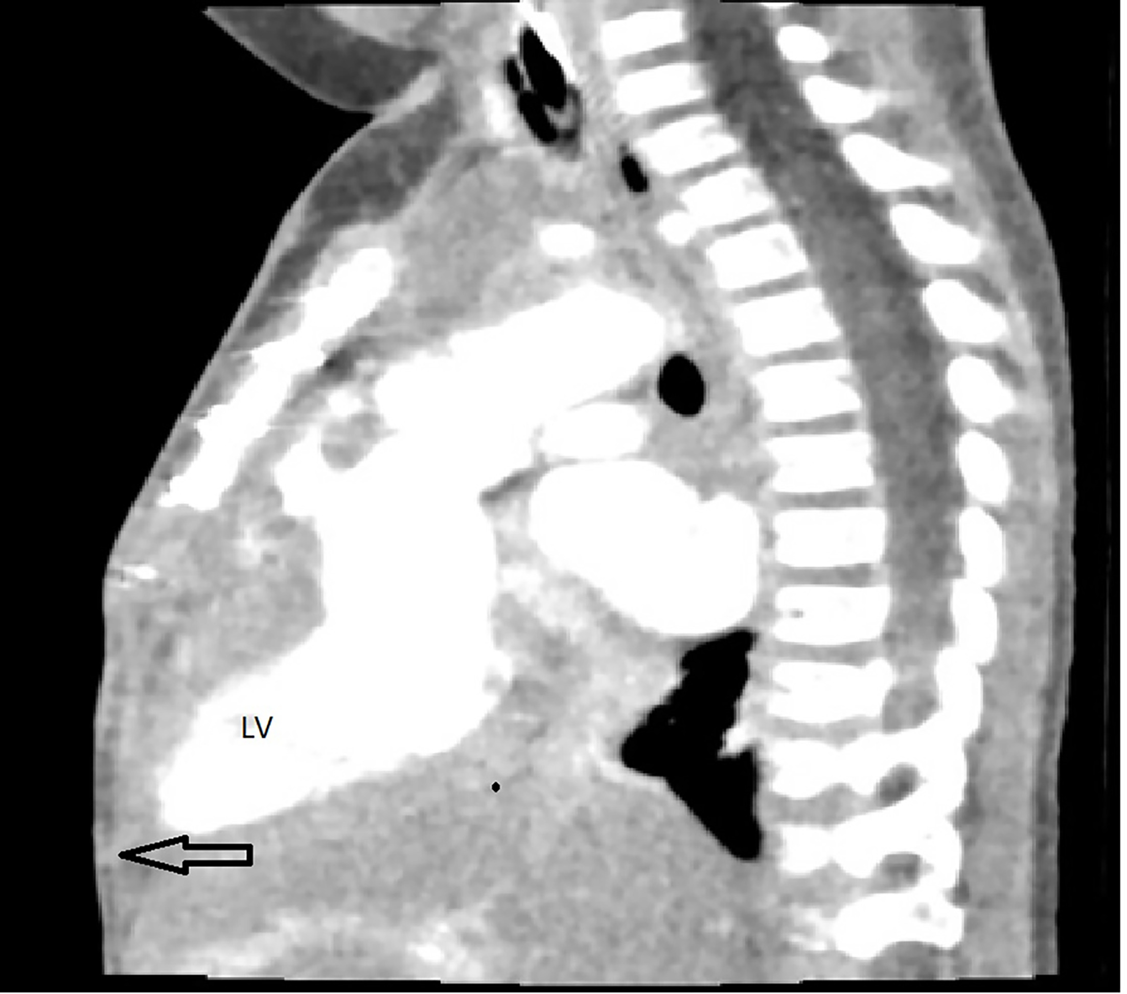 Sagittal contrast-enhanced CT angiogram of the chest demonstrating the left ventricular herniation through the anterior chest wall defect (arrow). LV, left ventricle.