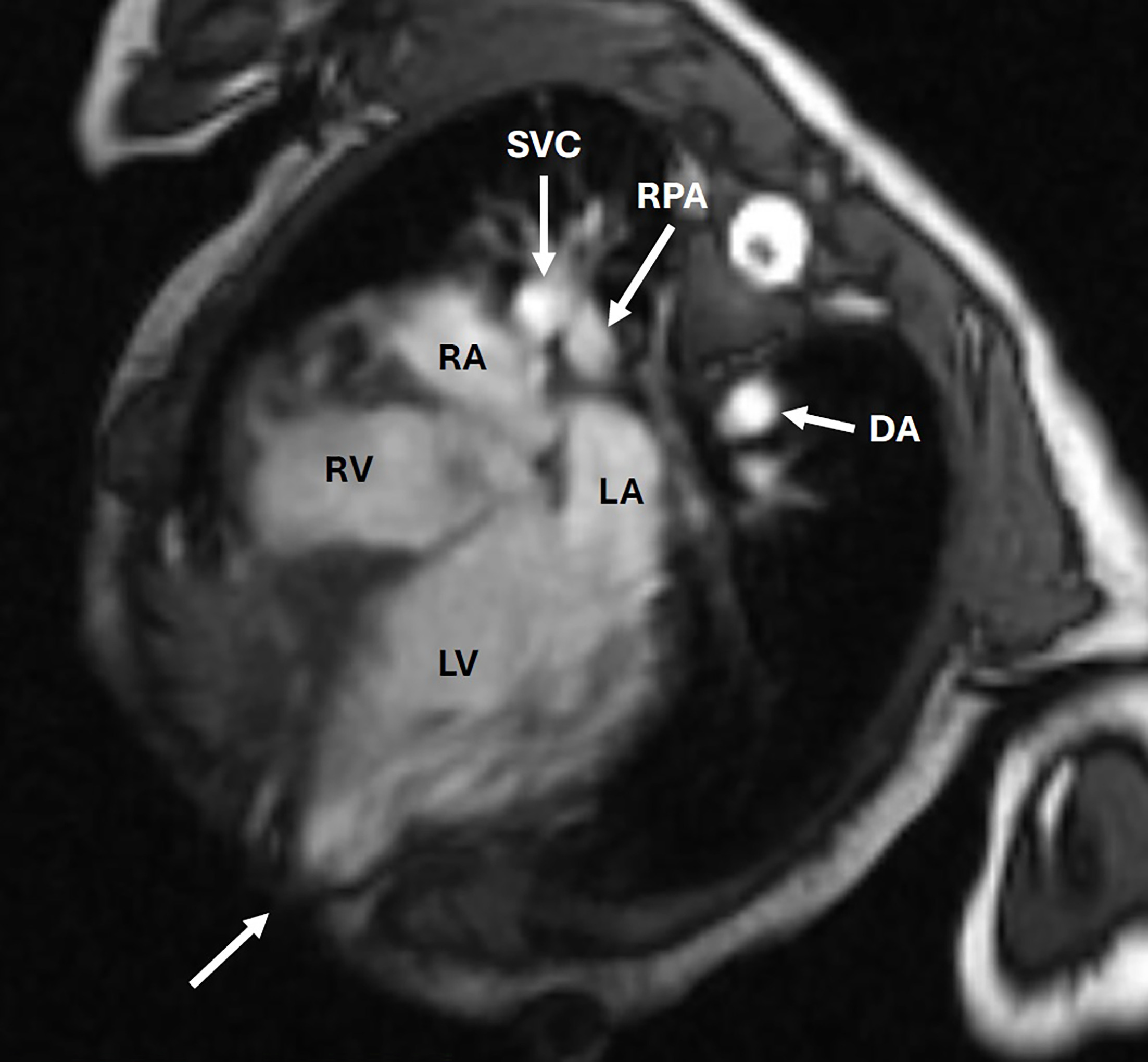 4-chamber SSFP at end-diastole. The left ventricle apex is just below the skin through a defect in the sternum and ribs (arrow). The right ventricle is normal in size with the left ventricle moderately dilated. The left and right atrium are normal in size. DA, descending aorta; LA, left atrium; LV, left ventricle; RA, right atrium; RPA, right pulmonary artery; RV, right ventricle; SVC, superior vena cava.