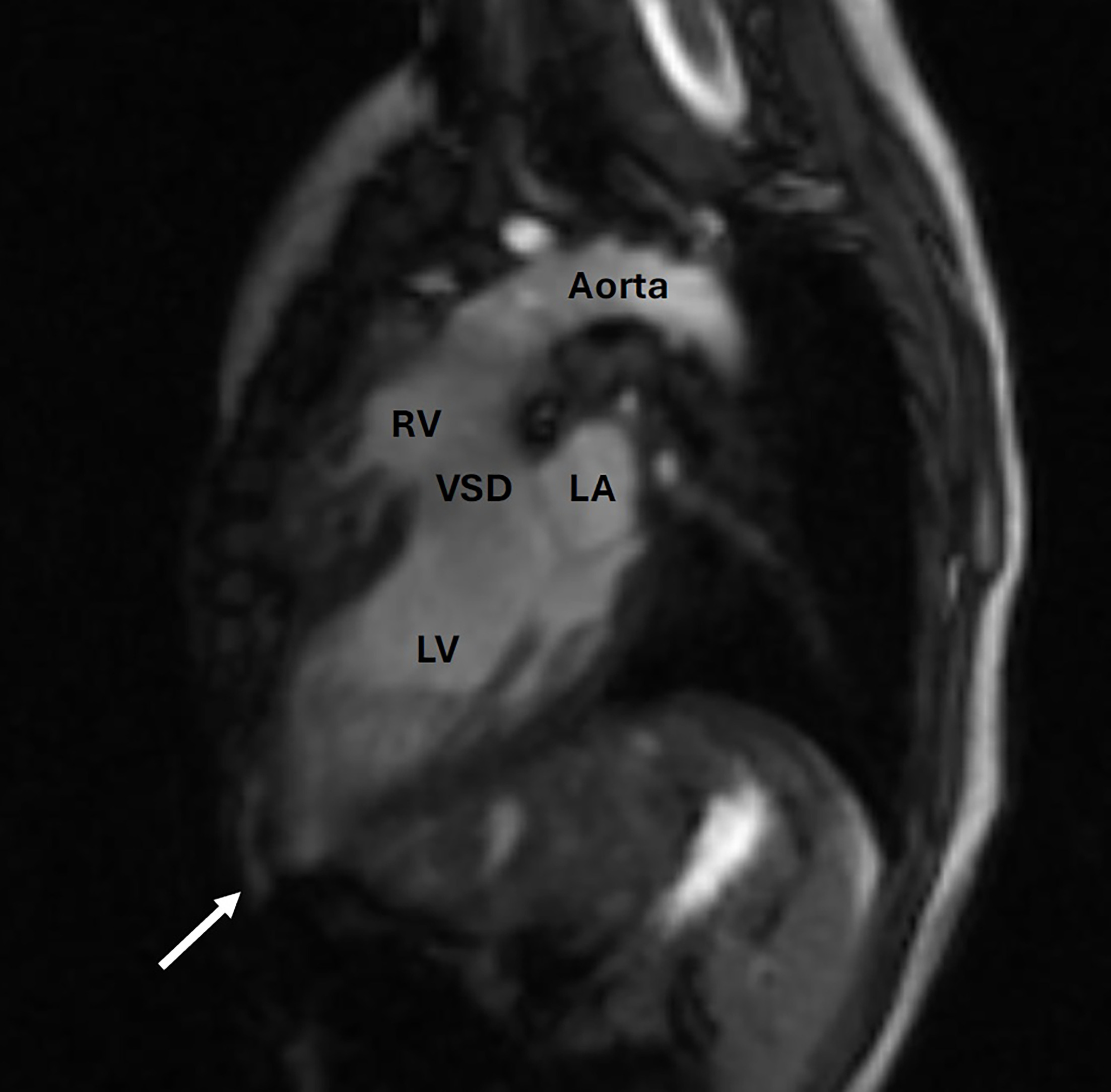 Left ventricular outflow tract SSFP at end-diastole. The left ventricle apex is just below the skin through a defect in the sternum and ribs (arrow). The left ventricle is moderately dilated, and the right ventricle is normal in size. The aorta arises from the right ventricle. There is a large ventricular septal defect. LA, left atrium; LV, left ventricle; RV, right ventricle; VSD, ventricular septal defect.