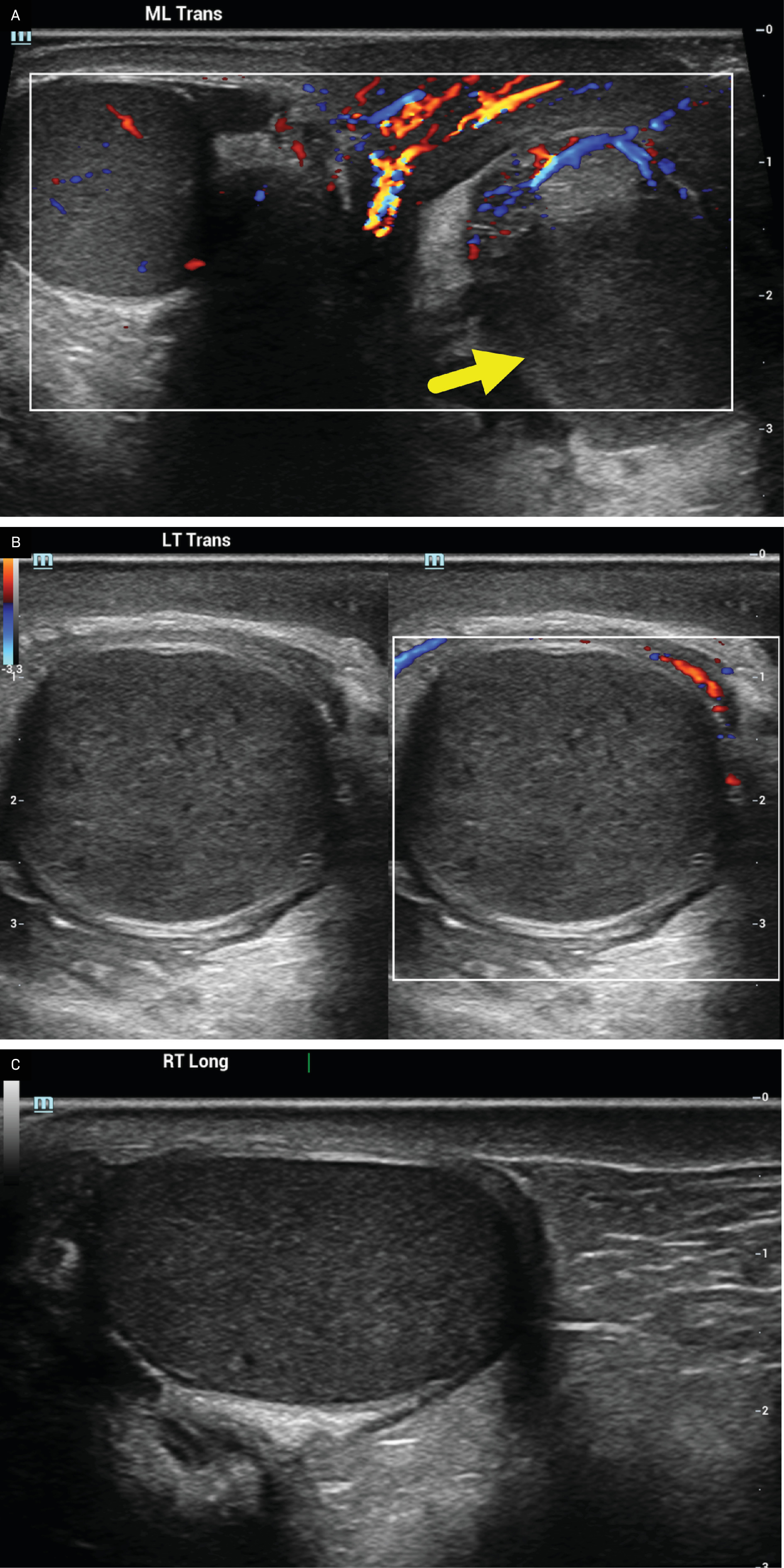 (A) Transverse color Doppler US of the scrotum showing the left testis (arrow) to have absent internal blood flow. There is relative surrounding hyperemia. (B) Transverse image of the left testis with and without color Doppler showing the testis to be enlarged, have a mildly heterogeneous echotexture, and mild surrounding hyperemia. (C) Longitudinal US image of the normal right testis for comparison.
