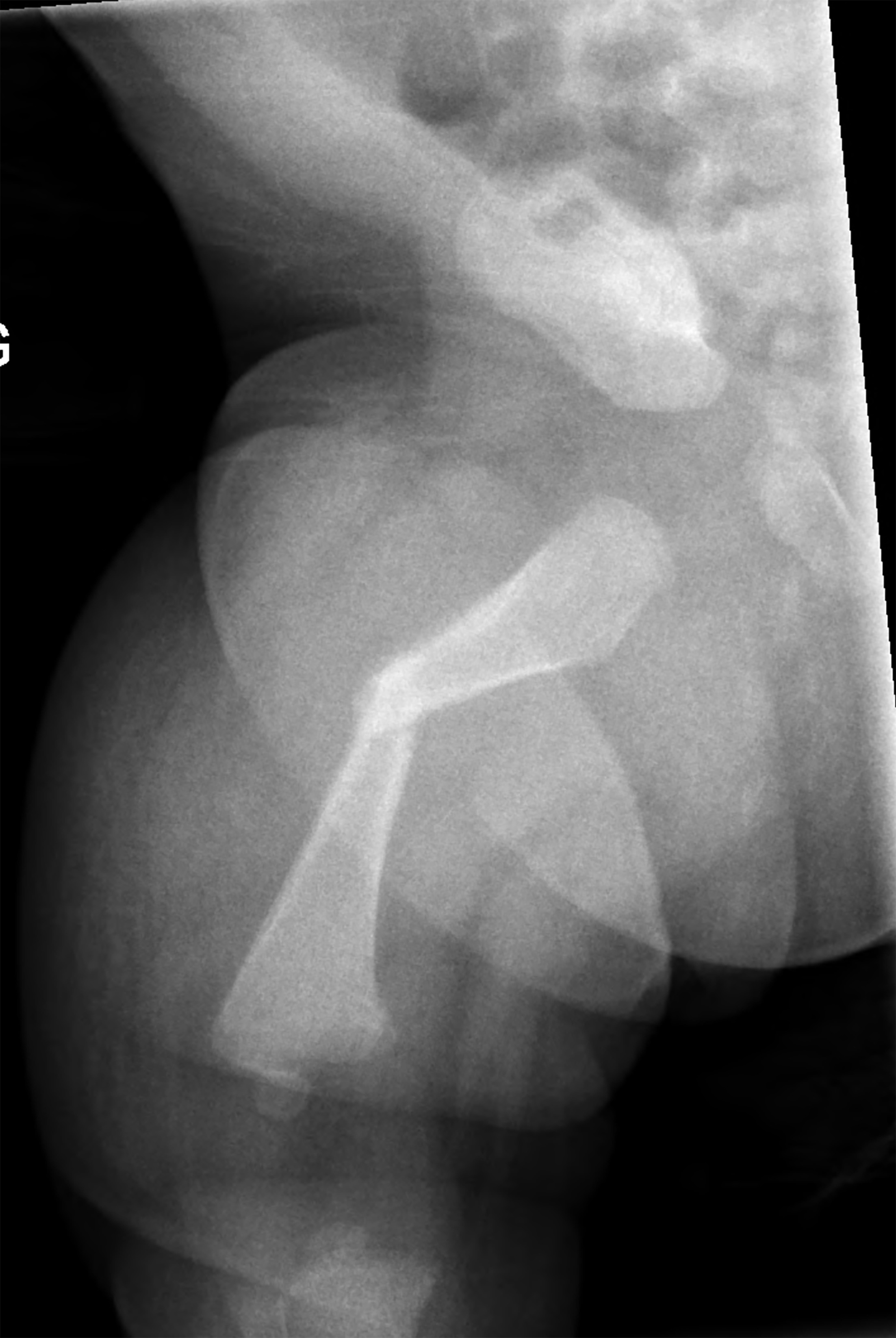 Radiograph of the right femur showing a transverse fracture of the mid diaphysis.