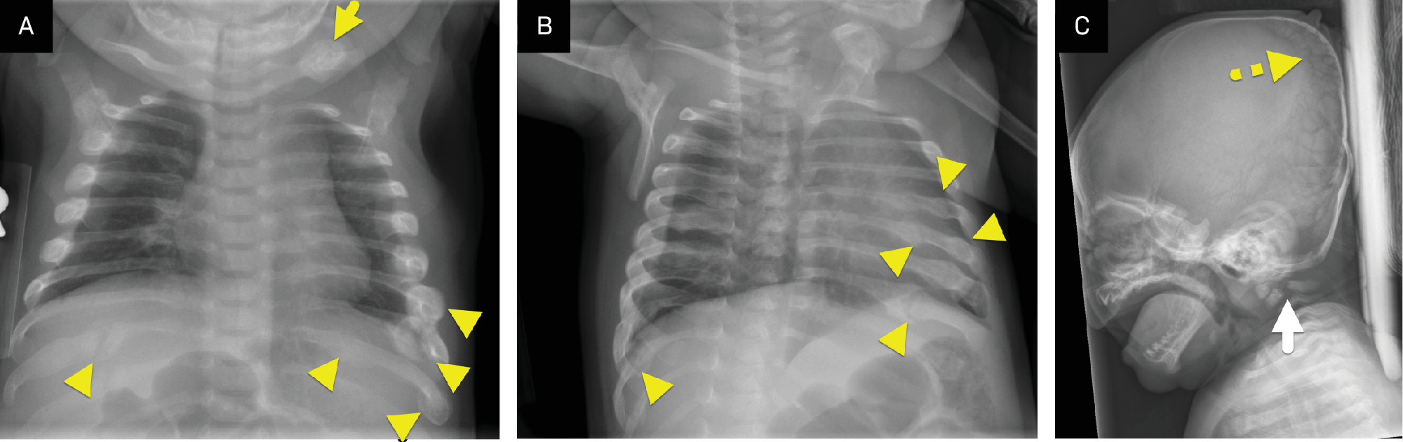 (A) Frontal image of the chest, (B) oblique view of the chest, (C) and lateral view of the skull and cervical spine obtained as part of a skeletal survey show multiple healing rib fractures (arrowheads), including multiple fractures within the same rib, a left clavicle fracture (arrow), a fracture through the pedicles of C2 (white arrow), and multiple Wormian bones (dashed arrow).