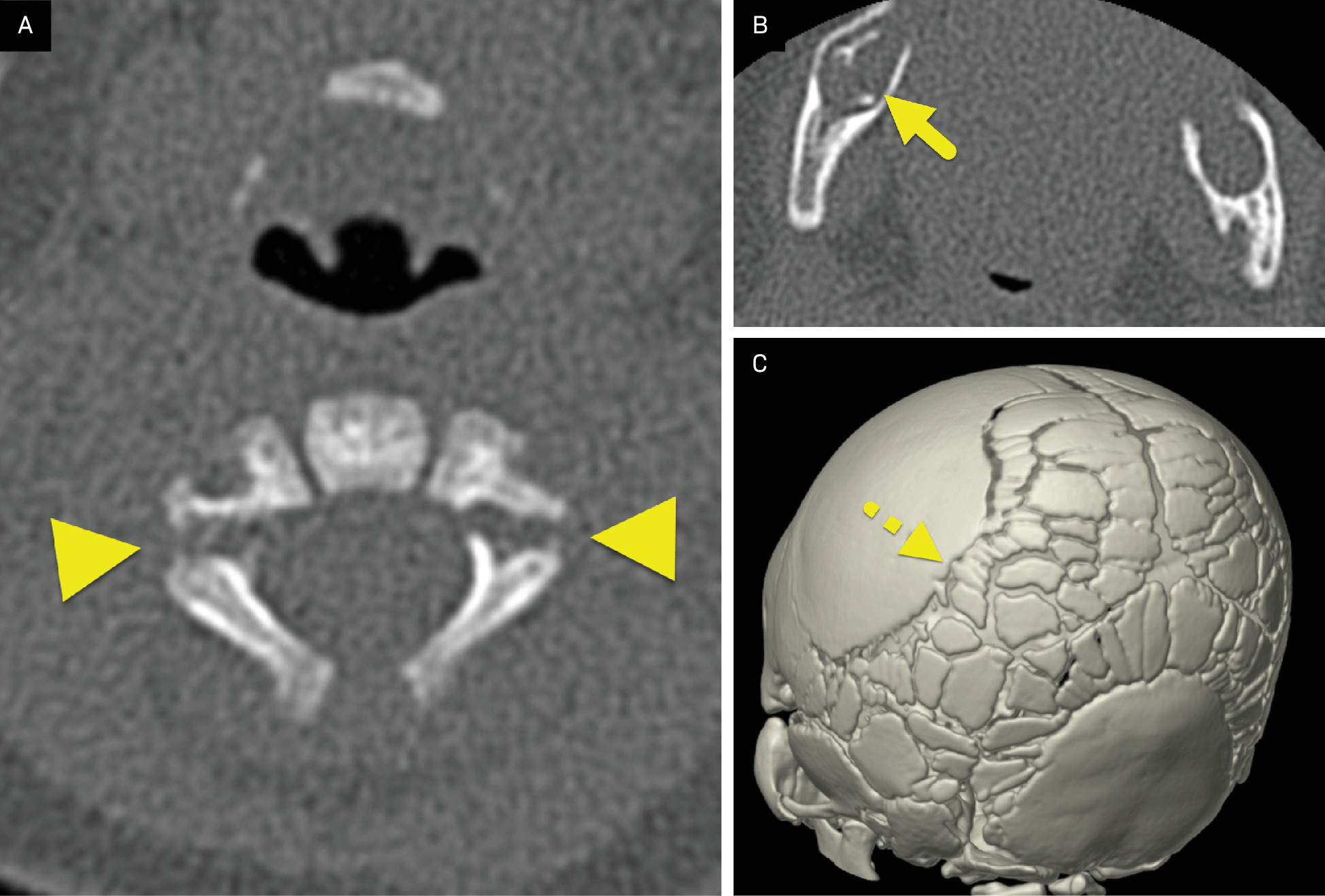 (A) Axial CT image through the C2 vertebral body showing a fracture of both pedicles (arrowheads). (B) Axial CT image through the mandible showing the absence of the normal lamina dura surrounding the teeth (arrow). (C) 3-dimensional reconstruction of the skull showing multiple Wormian bones (dashed arrow).