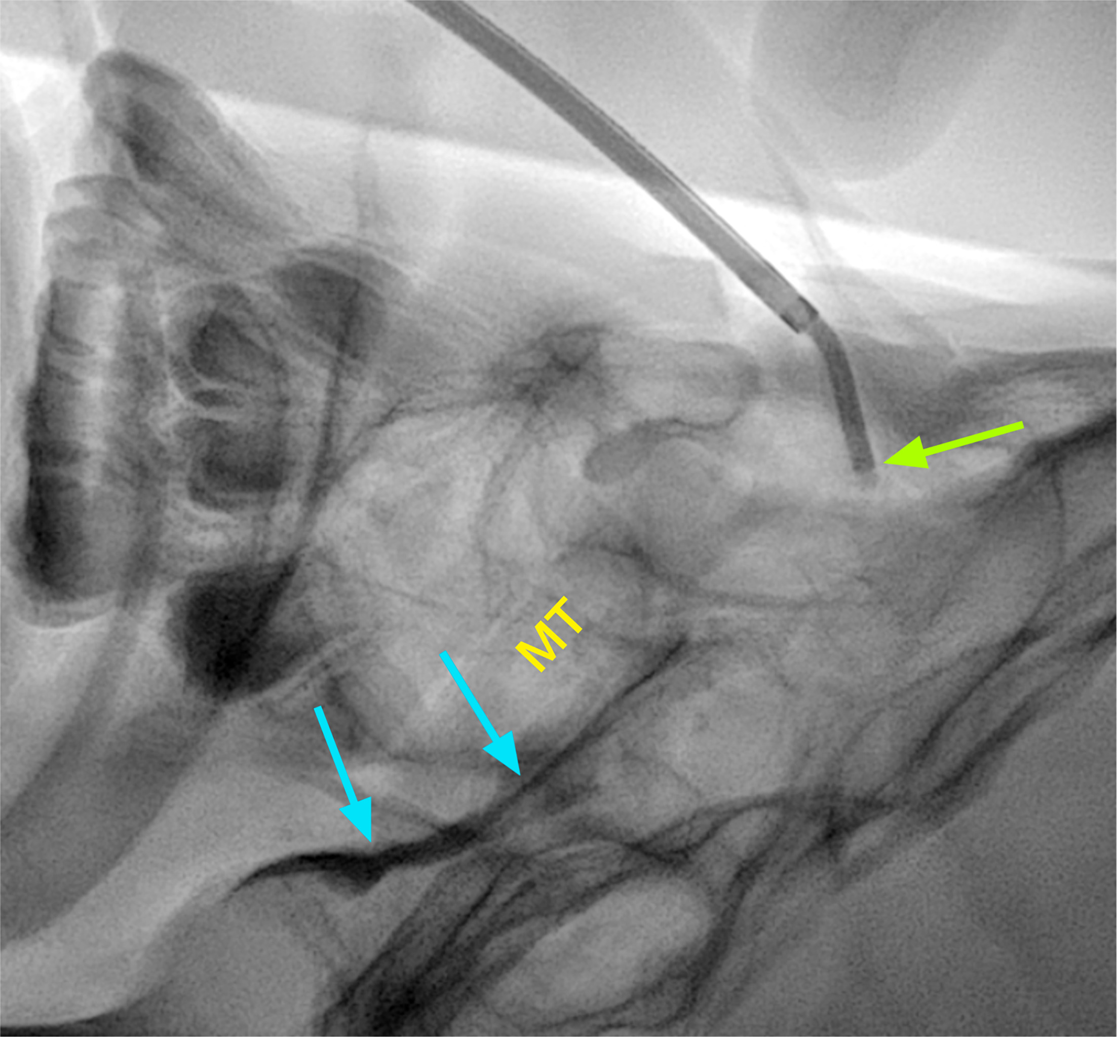 (A) Coned lateral fluoroscopic spot image demonstrating that the catheter tip (green arrow) is in a satisfactory position above the middle turbinate. Contrast outlining the nasopharynx (teal arrows) with confirming satisfactory position prior to injection of 2% lidocaine. MT, middle turbinate.
