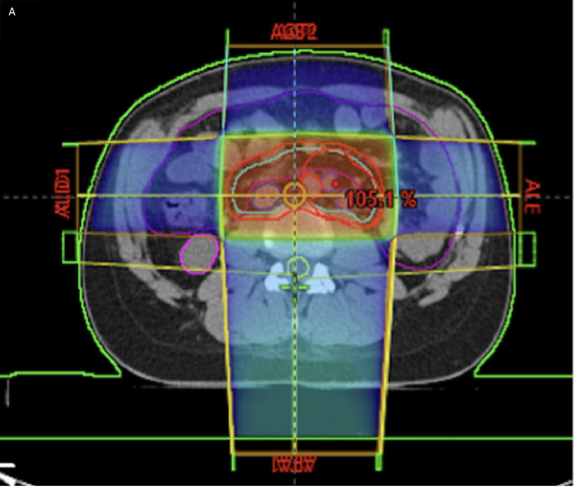 Axial external beam radiation treatment planning.12