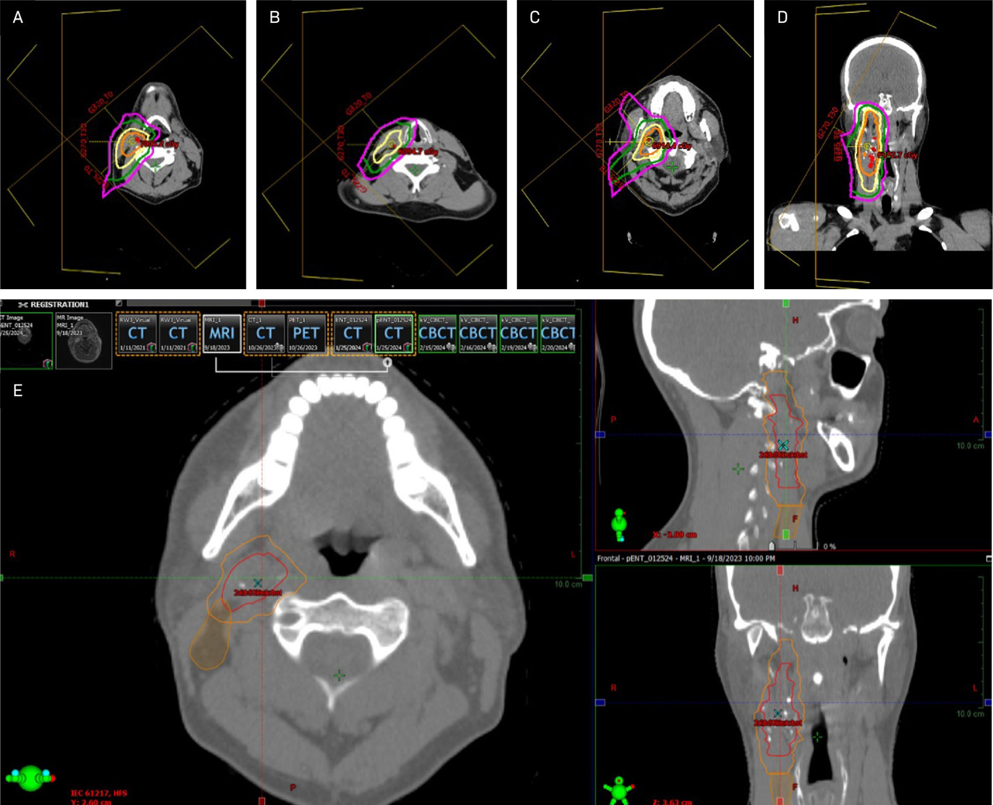 Intensity-modulated proton therapy planning with three anterolateral beams. The superior field (A, B), mid-field (C, D), and inferior field (E) are depicted. 1