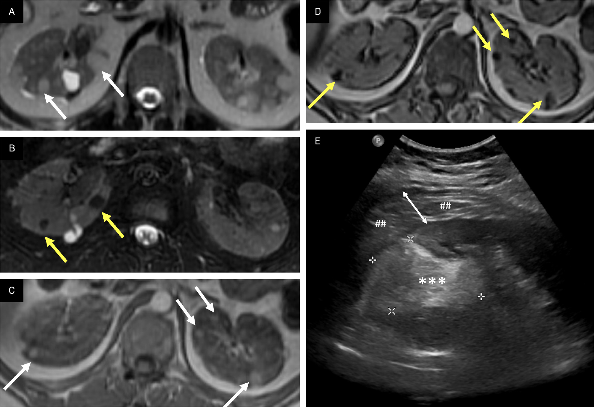 Lipid-rich angiomyolipoma (AML). AMLs typically contain macroscopic or bulk fat and can also contain microscopic or intravoxel fat. Intermediate lesions on T2 image (A, arrows) demonstrate loss of signal on T2-fat saturated image (B, arrows), indicating macroscopic fat. Phase imaging with T1 intermediate lesions in the kidneys (C, arrows) demonstrates loss of signal in the opposed phase image, indicating microscopic/intravoxel fat in AMLs (D, arrows). A large, left mid-to-superior renal pole echogenic lesion (E, asterisks and calipers) containing echogenic fat was found to be a ruptured AML with perinephric hematoma (##), whose thickness is delineated by the white double-headed arrow.