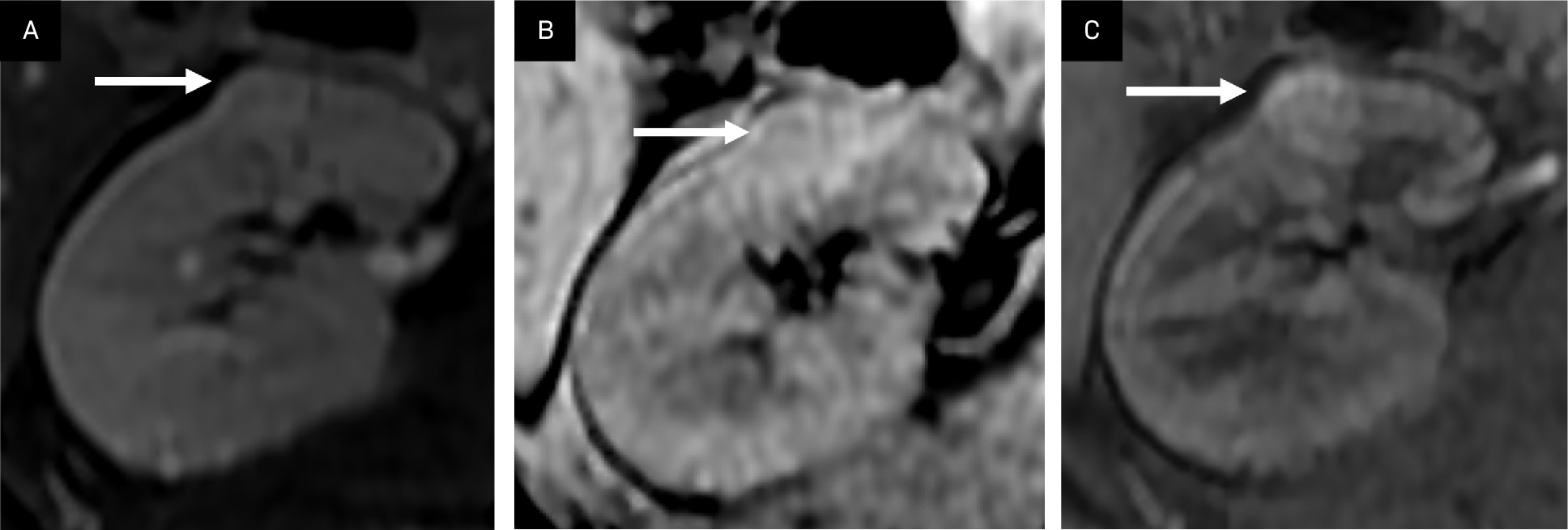 Lipid-poor angiomyolipoma (AML). A T2 isointense renal lesion without significant loss of signal in the frequency fat-saturated sequence (T2 FS) suggesting the presence of macroscopic fat (A, arrow), and no loss of signal in the T1 opposed phase sequence suggesting microscopic/intravoxel fat (B, arrow) demonstrates mild arterial enhancement in the T1 fat-saturated, contrast-enhanced image (C, arrow). This lesion can be difficult to distinguish from a renal cell carcinoma.