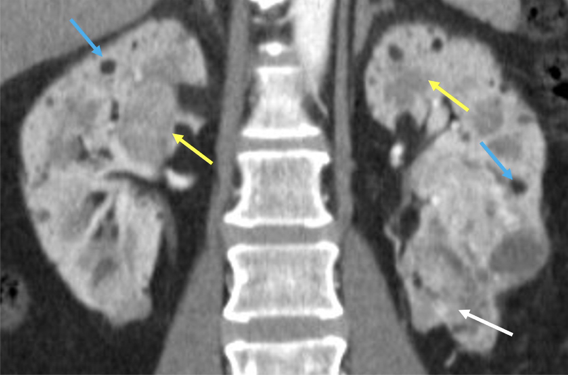 Variable appearances of renal angiomyolipomas (AMLs) in tuberous sclerosis complex. Predominantly macroscopic fat-containing AMLs show low CT attenuation with macroscopic fat <-10 HU (blue arrows). Lipid-poor AMLs with a more smooth muscle component are higher attenuation (yellow arrows). A more complex AML containing smooth muscle, vascular components, and tiny amounts of fat is seen in the left inferior renal pole (white arrow).