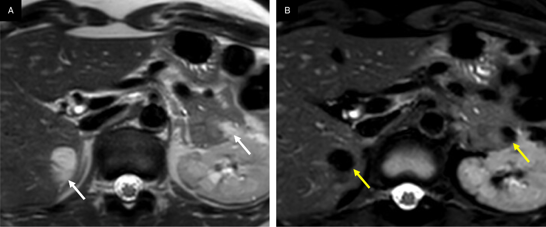 Multiorgan angiomyolipomas (AMLs). Hepatic and pancreatic AMLs appear as regions of T2 hyperintensity in the liver and pancreas in T2. MR image (A, arrows) with loss of signal in the frequency selective fat-saturated T2 MR image (B, arrows).