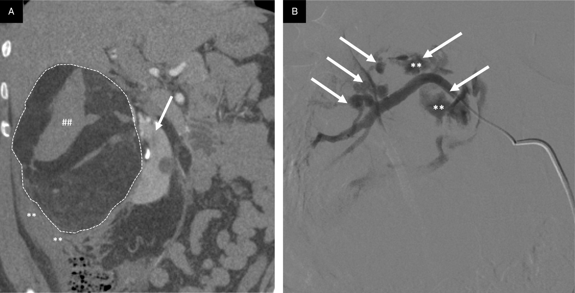 Angiomyolipoma (AML) rupture. AMLs > 4 cm or containing pseudoaneurysms > 0.5 cm have an increased propensity to bleed. (A) Coronal CT reformation through large, ruptured AML with macroscopic fat (dotted white lines outlining lesion) in the right kidney (arrow) with resultant perinephric hematoma (**) and internal hemorrhage (##). (B) Selective catheter arteriogram following AML rupture demonstrating multiple pseudoaneurysms (arrows), 2 with contrast extravasation indicating active hemorrhage (**).
