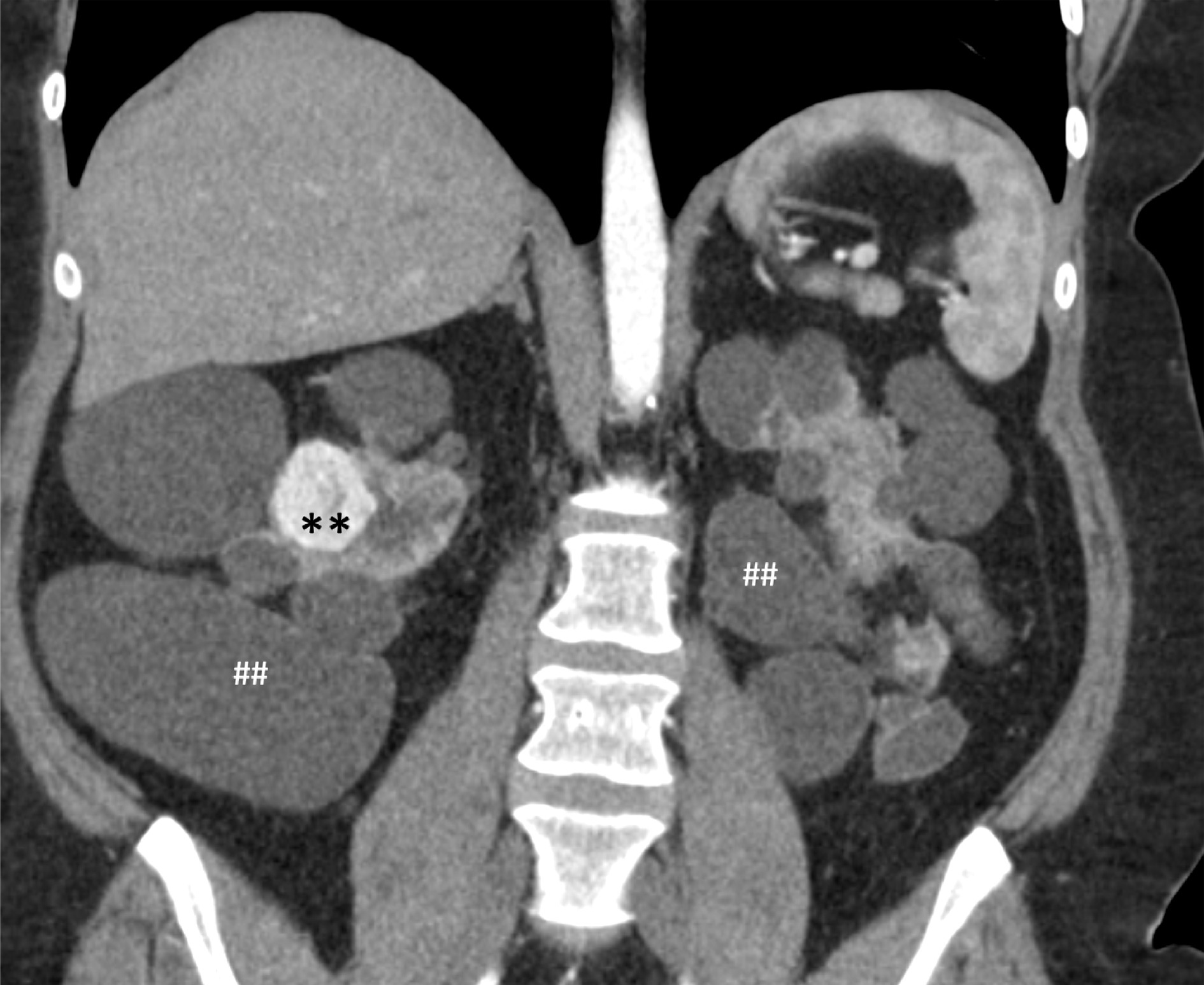 Renal cysts and renal cell carcinoma. Coronal CT reformation in a patient with tuberous sclerosis complex, end-stage renal disease, and associated polycystic kidney disease was found to have an avidly arterially enhancing right renal mass diagnosed as renal cell carcinoma (**) on a background of multiple renal cysts (##).