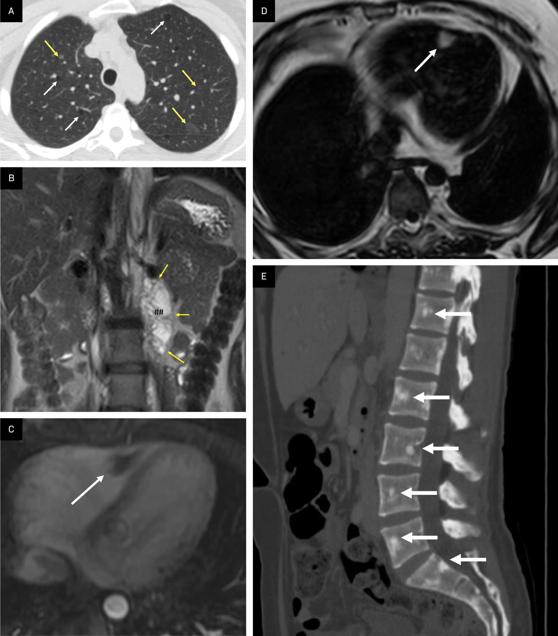 Other manifestations of tuberous sclerosis complex (TSC). (A) Axial CT showing pulmonary lymphangioleiomyomatosis characterized by thin-walled cysts (white arrows) and micronodular pneumocyte hyperplasia manifested by ground glass nodules (yellow arrows) in a patient with TSC. (B) Coronal T2 MRI showing how lymphangioleiomyomas can develop in the retroperitoneal region as in this T2 hyperintense signal mass (##, arrows) in the left retroperitoneal region abutting the left kidney. (C) T1 fat-saturated postcontrast axial image of the heart demonstrating a nonenhancing rhabdomyoma (white arrow) in the right ventricle. (D). Dixon fat-only MRI sequence with a tumor containing macroscopic fat at the ventricular septum (arrow) TSC appearing as a hyperintense lesion consistent with a cardiac angiomyolipoma. (E) Sagittal CT reformation of the spine in a patient with TSC and multiple sclerotic bony lesions in the vertebral bodies (arrows).