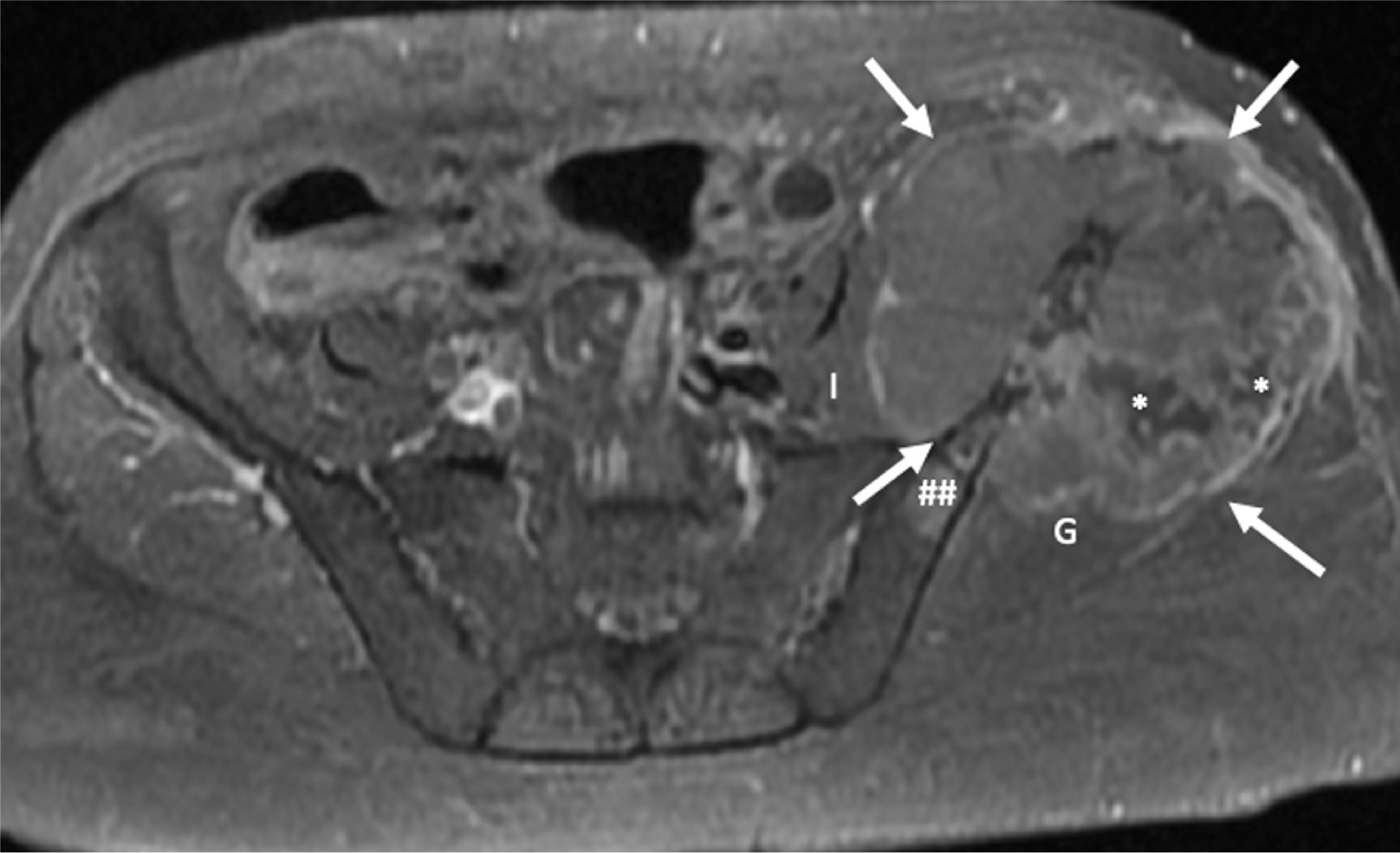 Aggressive malignant perivascular epithelioid cell tumor (PEComa). T1-fat saturated postcontrast MRI demonstrates an expansile and aggressive left pelvic lesion (arrows) eroding the left iliac crest and invading the adjacent left gluteal (G) and left iliopsoas (I) muscles. The tumor is heterogeneously enhanced with areas of internal necrosis (*) and was proven to be a recurrent malignant PEComa in a patient with a previous pulmonary PEComa that was treated and subsequently resected. A satellite lesion in the left iliac bone is also seen (##).