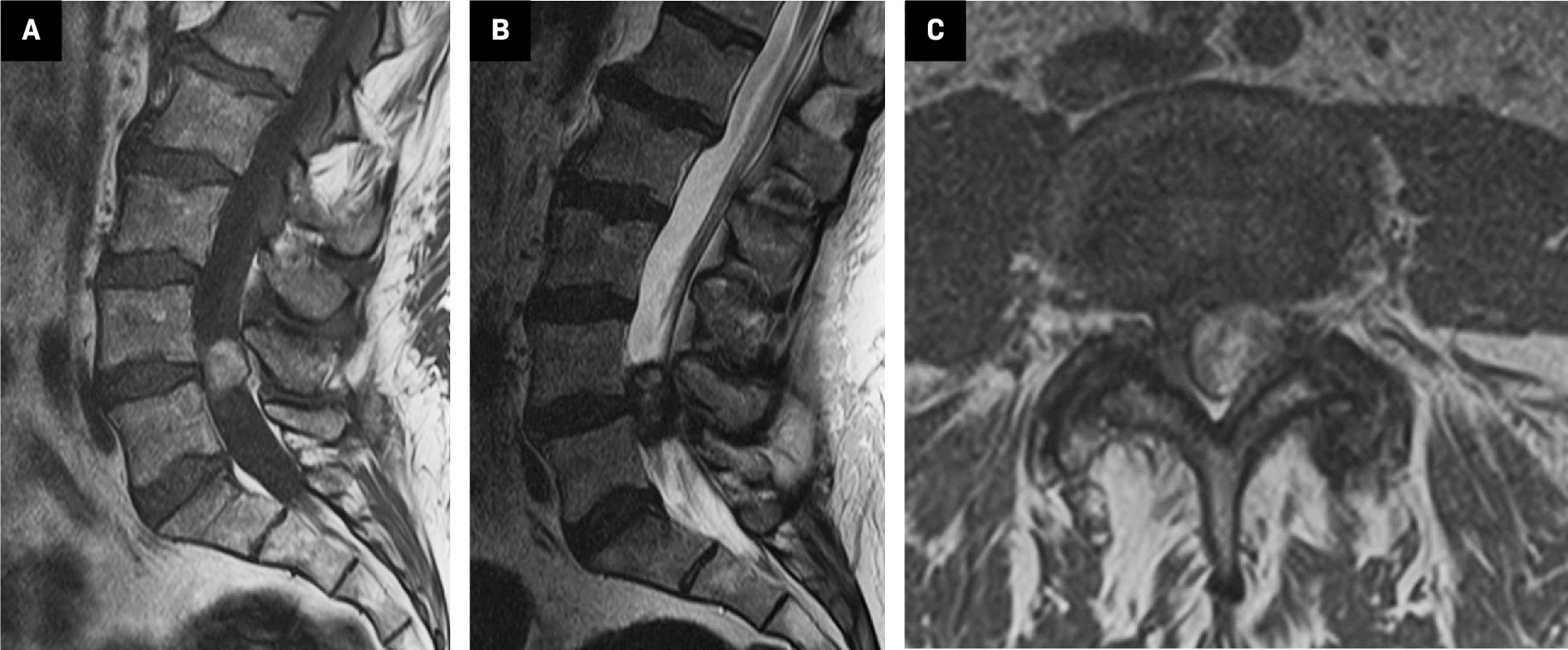 MRI of lumbar spine without contrast. (A) Sagittal T1 image demonstrates the hyperintense T1 signal epidural mass at L4-L5. (B) Sagittal T2 image demonstrates the hypointense T2 signal epidural mass at L4-L5. (C) Axial T1 image demonstrates the hyperintense T1 signal mass projecting medially from the left facet joint in the left dorsolateral epidural space.