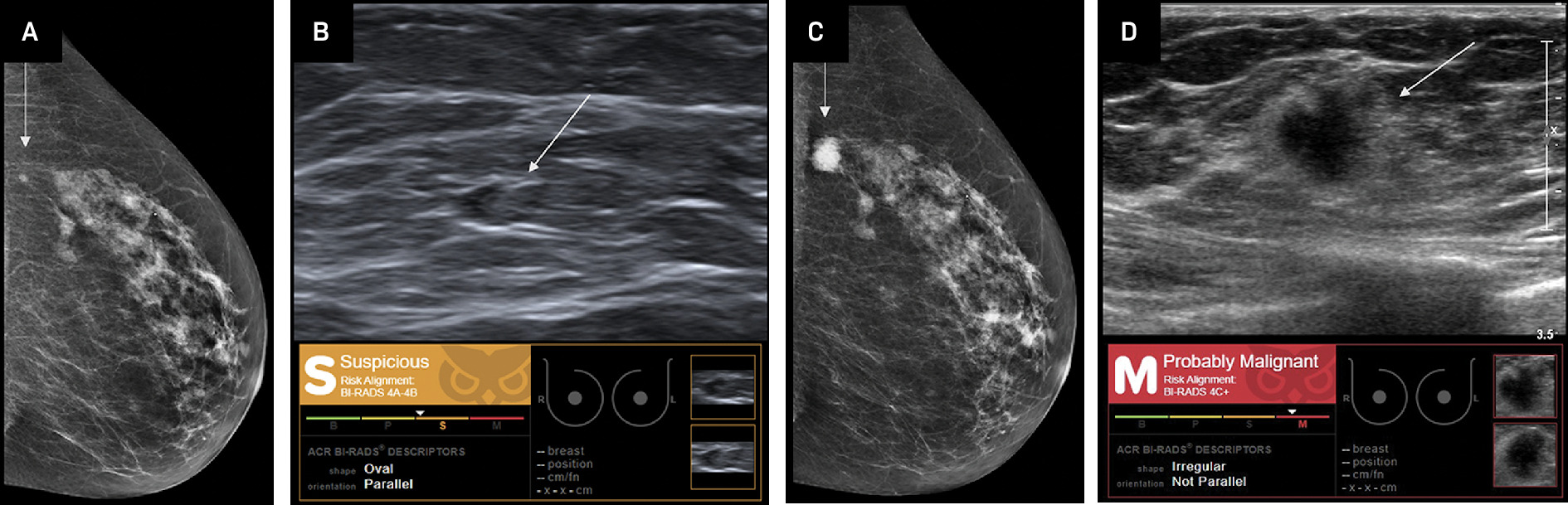 Invasive ductal carcinoma (IDC). Craniocaudal mammographic view (A) and breast US (B) demonstrate a left breast mass (arrow) that was retrospectively assessed as “suspicious,” BI-RADS category 4A-4B by Koios artificial intelligence (AI) Decision Support (DS). This mass was reported as “probably benign” by a radiologist. At the 6-month follow-up, left breast craniocaudal mammogram (C) and breast US (D) demonstrate that the mass (arrow) has increased in size. The mass is assessed as “probably malignant,” BI-RADS category 4C+ by Koios AI DS owing to its irregular shape and nonparallel orientation. Biopsy demonstrated triple-negative IDC. Images from Coffey et al.14 Images courtesy of Koios Medical, Inc.