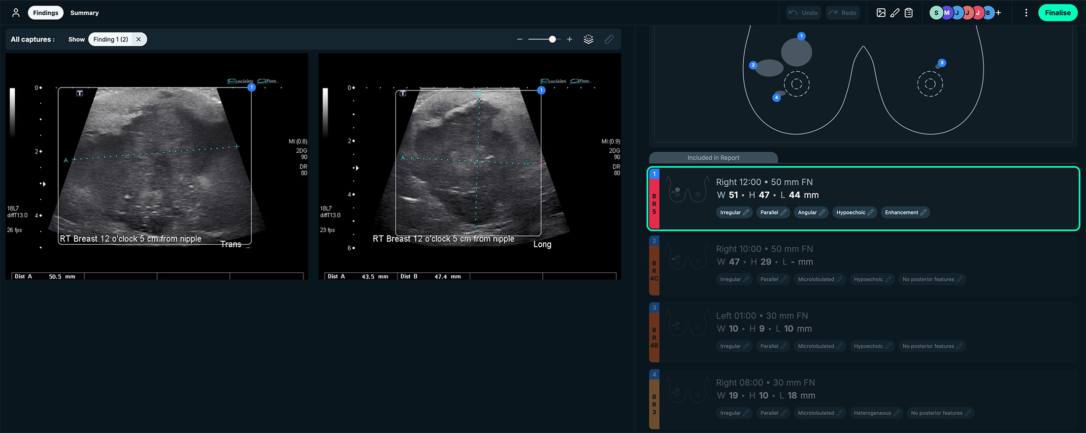 BI-RADS 5. See-Mode’s interface displays the clockface location of the lesion of interest and displays measurements side by side with the US images. This case was a BI-RADS 5 classification, owing to irregular shape, angular margins, and hypoechoic echo pattern. Images courtesy of See-Mode.