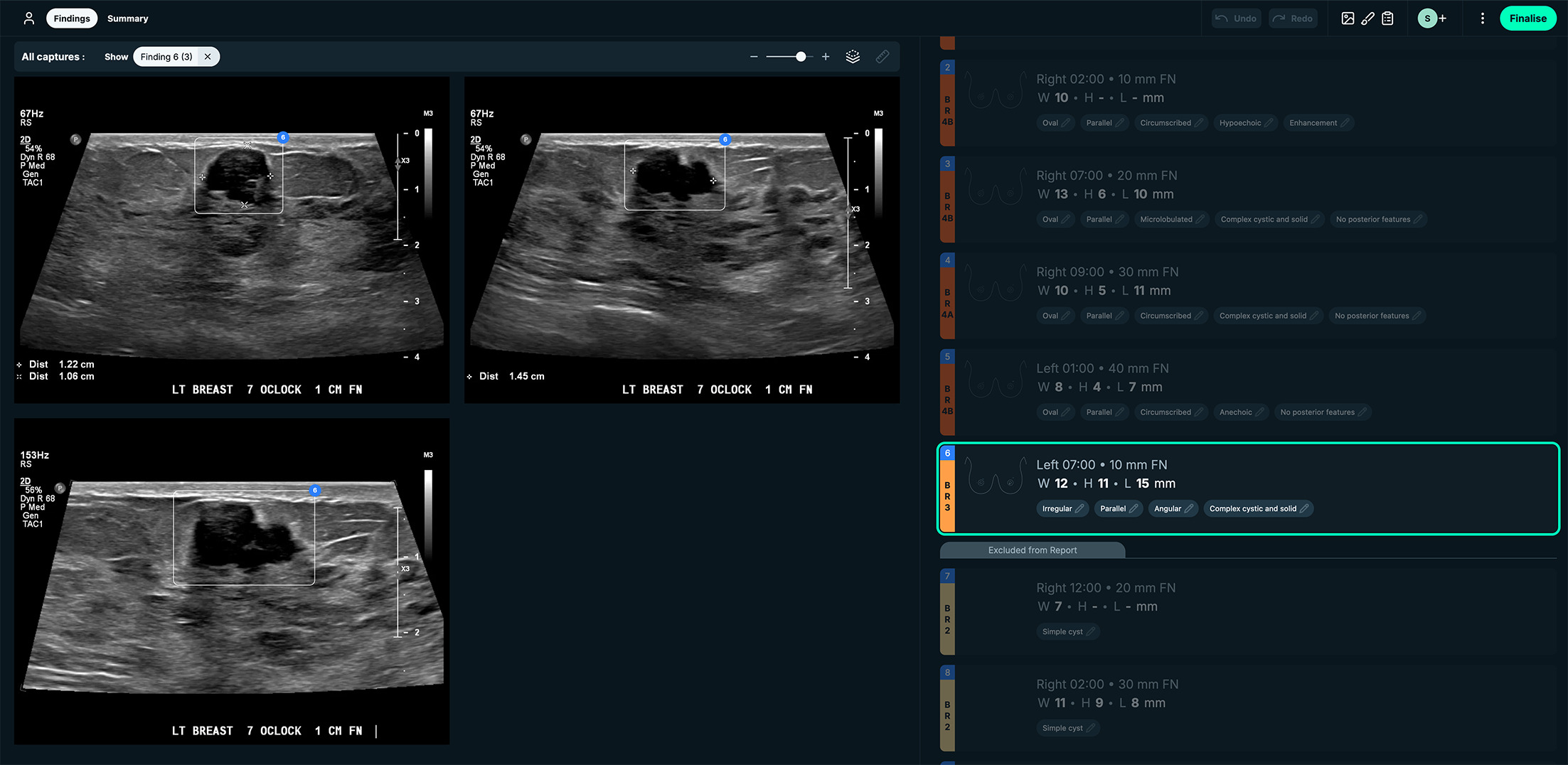 BI-RADS 3. See-Mode’s interface displays lesion measurements side by side with the US images. This case was a BI-RADS 3 classification due to irregular shape, angular margins, and complex cystic and solid appearance. Images courtesy of See-Mode.