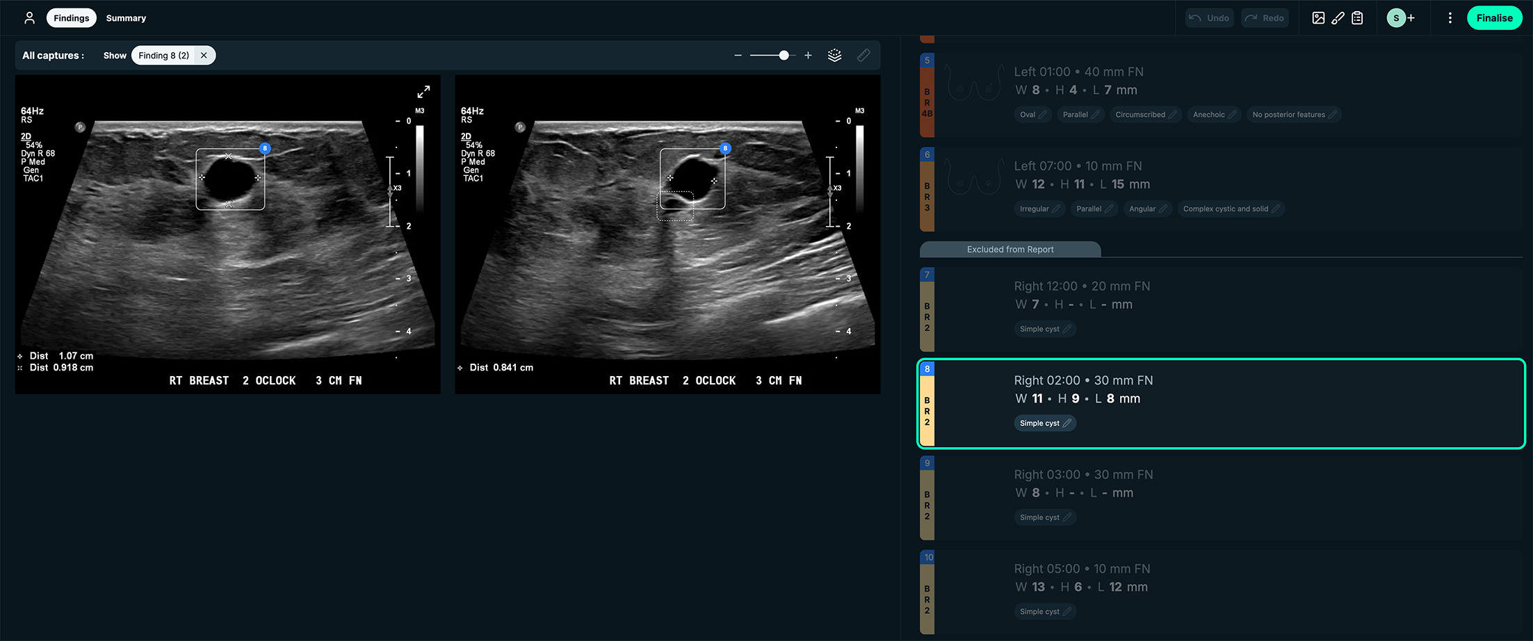 BI-RADS 2. See-Mode’s interface displays lesion measurements side by side with the US images. This case had a simple cyst appearance. Images courtesy of See-Mode.