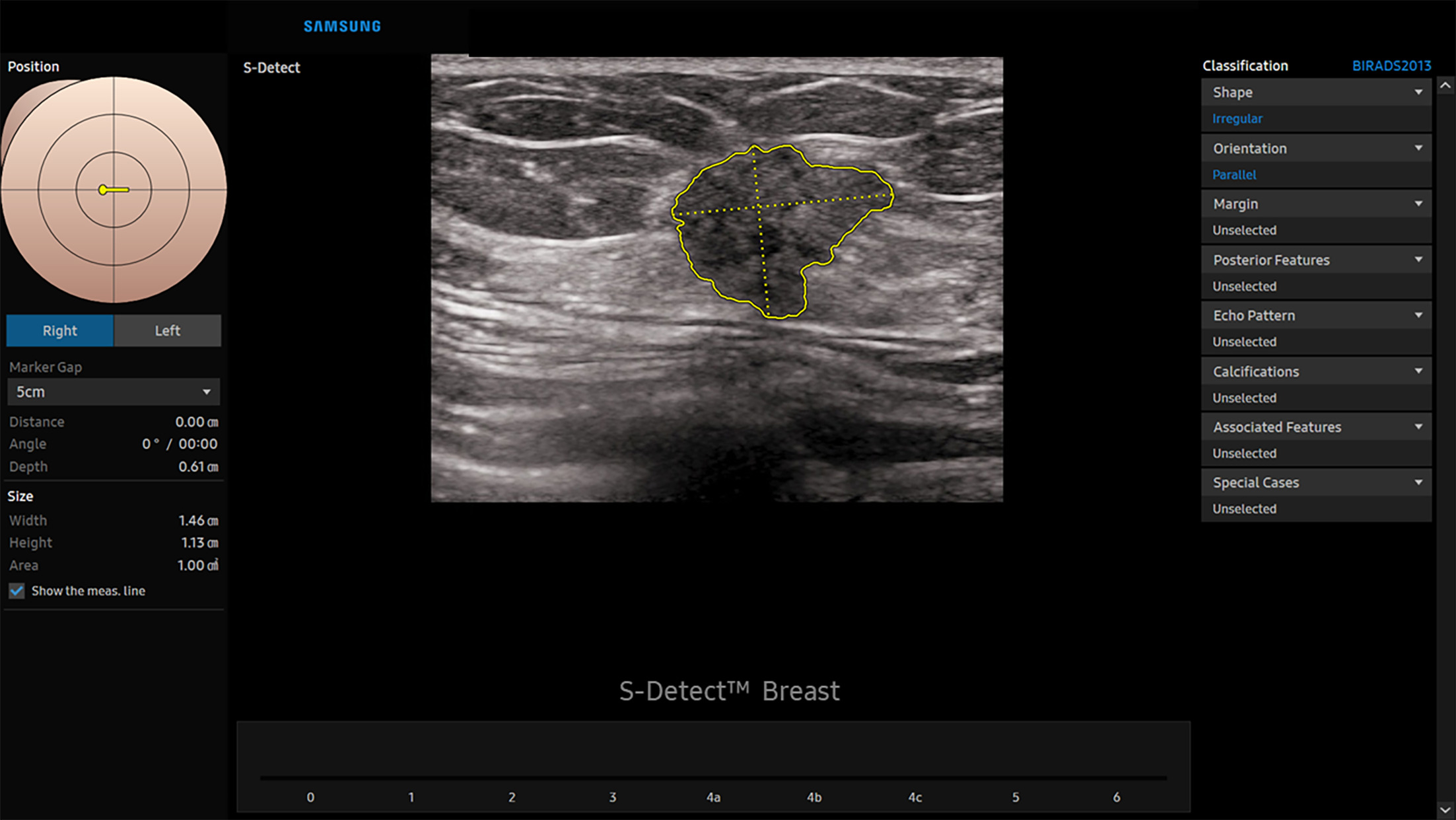 Irregular mass. S-Detect artificial intelligence Decision Support creates a lesion map with position and measurements on the left side of the figure, US image in the center, and selected classification features on the right. This mass was classified as irregular shape and parallel orientation. Images courtesy of Samsung Electronics.