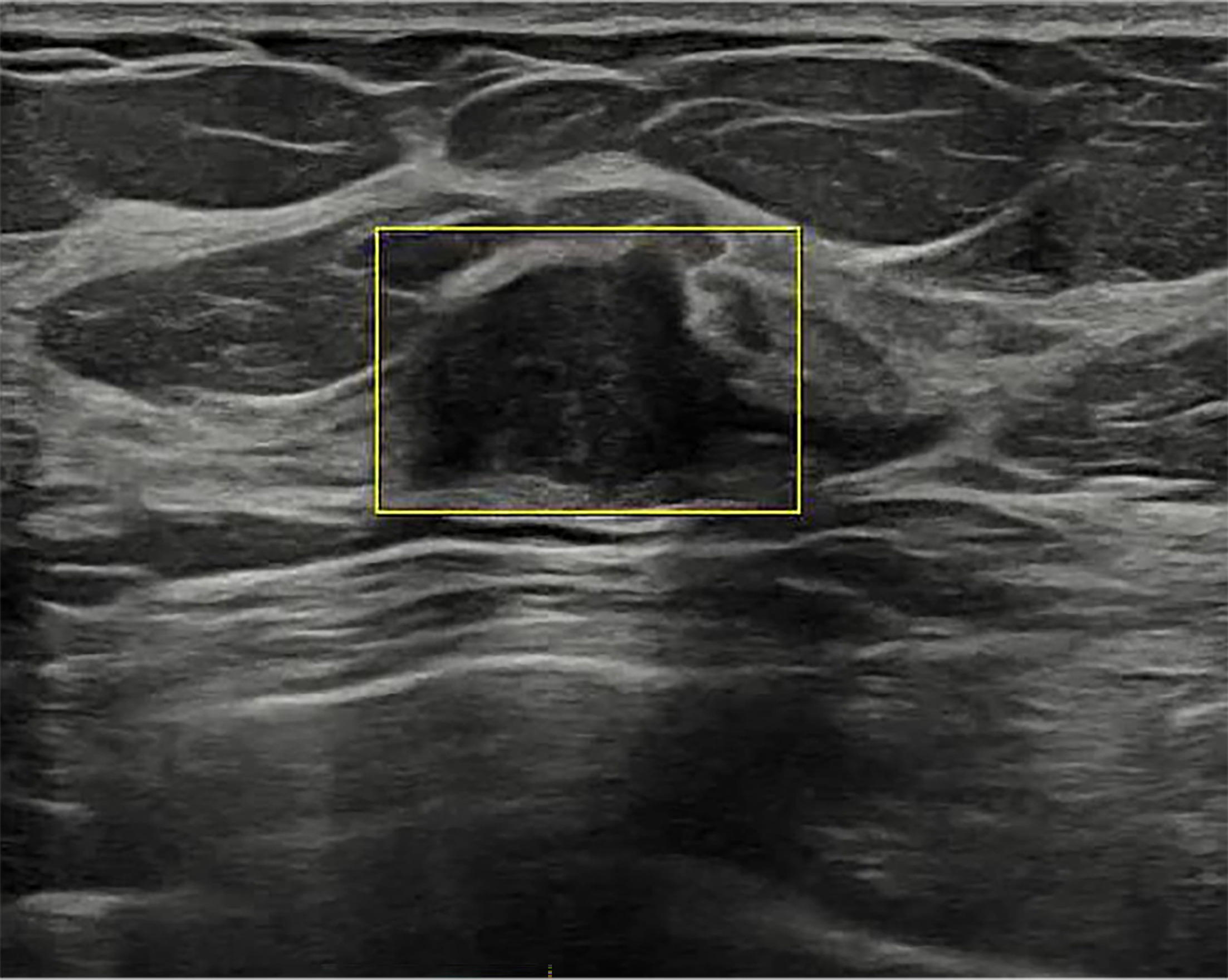 Artificial intelligence (AI) lesion detection. S-Detect AI Decision Support has a US Food and Drug Administration-pending feature that detects potentially abnormal findings and displays a yellow box to highlight the finding to the sonologist during live US scanning of the breast. Images courtesy of Samsung Electronics.