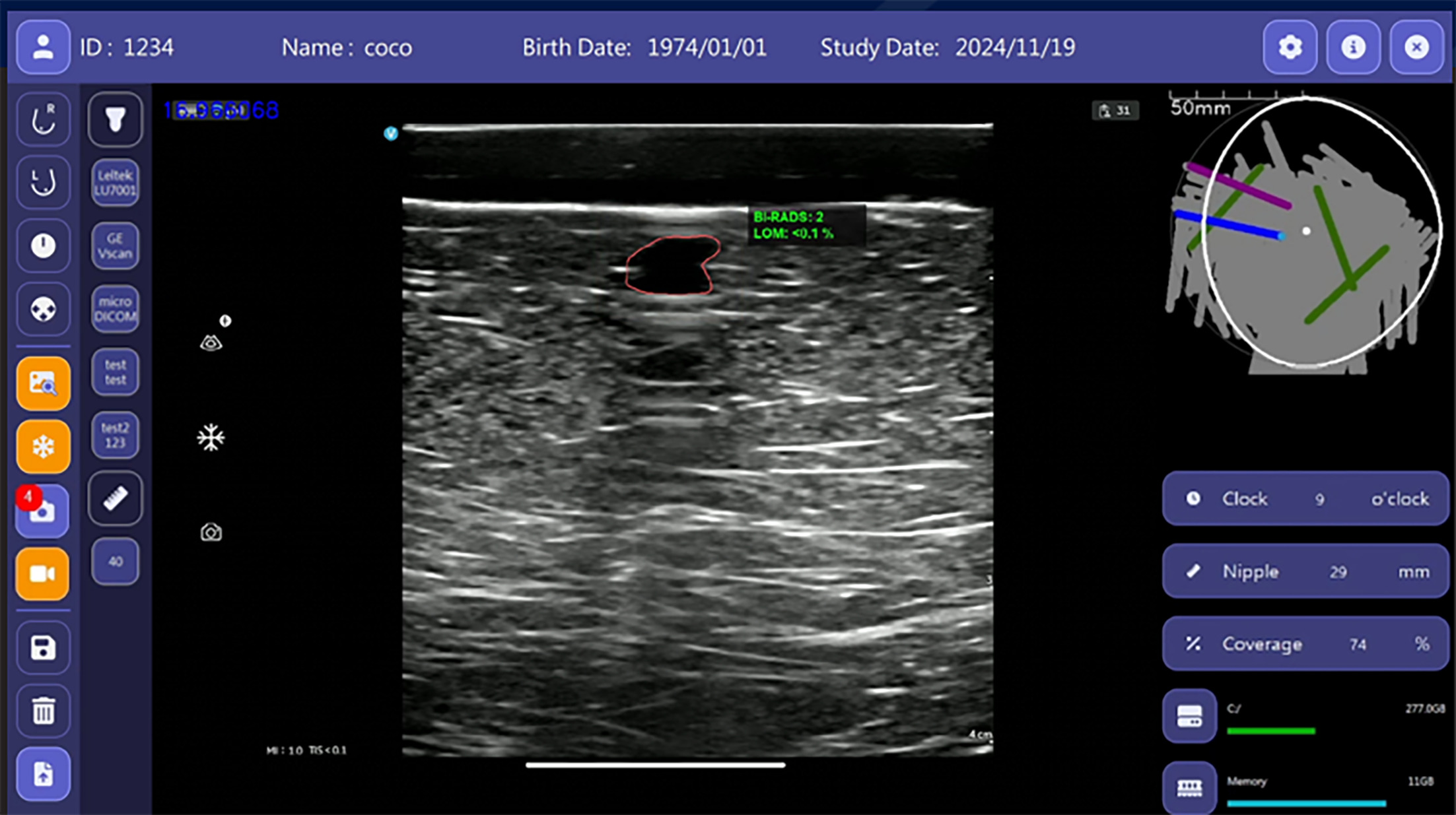 BI-RADS 2. Breast Ultrasound Computer-Aided Diagnosis interface showing a navigation bar on the left and an US image with the outlined lesion in the center. The right side displays a map of the probe on the breast (top right) with clock face coordinates below. This mass was categorized as BI-RADS 2, likelihood of malignancy < 0.1%. Image courtesy of TaiHao Medical Inc.