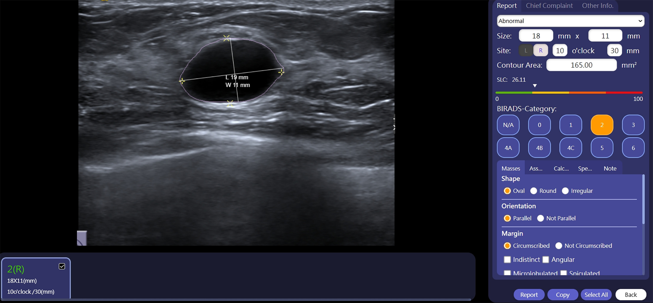 BI-RADS 2. Breast Ultrasound Computer-Aided Diagnosis interface with the US image of the outlined lesion with accompanying measurements in the center. This mass was categorized as BI-RADS 2 based on its oval shape, parallel orientation, and circumscribed margins. Image courtesy of TaiHao Medical Inc.