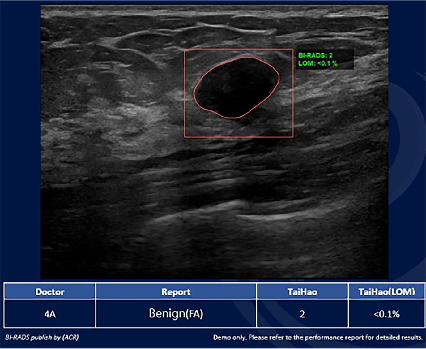 Artificial intelligence/radiologist discrepancy. Breast Ultrasound Computer-Aided Diagnosis (BU-CAD) interface with the US image of the outlined lesion. This mass was categorized as BI-RADS 2, <0.1% likelihood of malignancy (LOM). At the bottom, the radiologist’s assignment of BI-RADS 4A and TaiHao’s BU-CAD assignment of BI-RADS 2 are displayed. This mass demonstrated benign pathology via fine needle aspiration. Image courtesy of TaiHao Medical Inc.