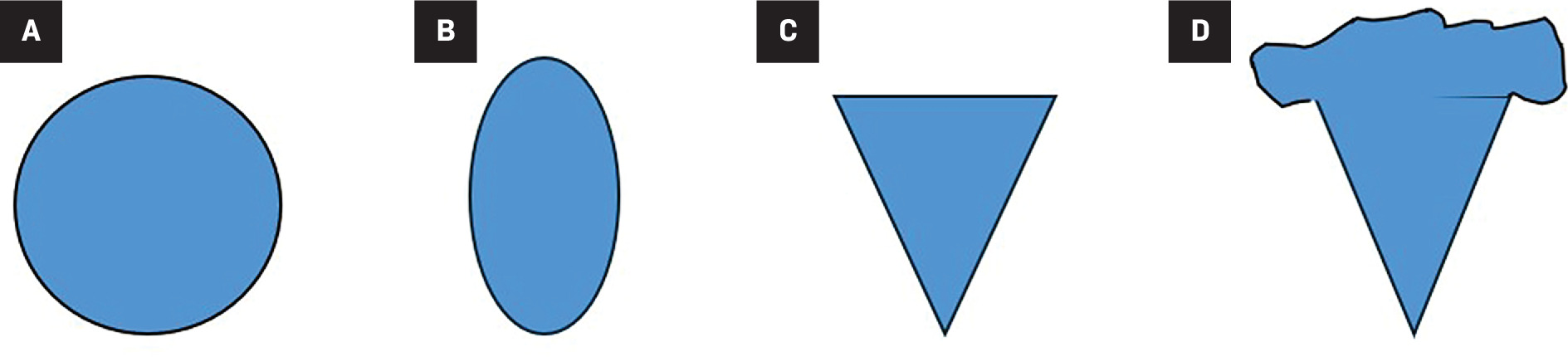 Renal cell carcinomas are most commonly round in shape (A), while angiomyolipomas (AMLs) have variable shapes including oval (B), angular interface (C), and “overflowing beer” sign in some peripheral AMLs (D).