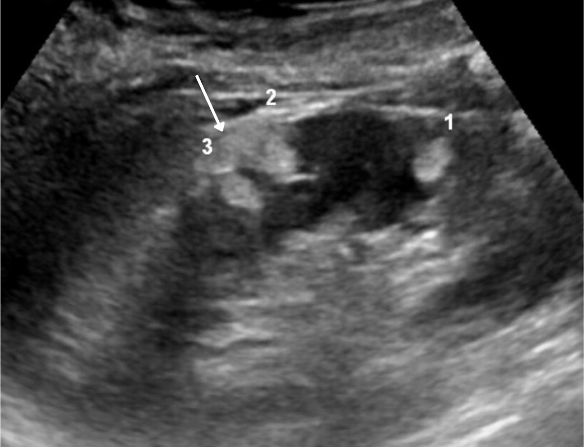 Renal US in an adult with multiple angiomyolipomas, including 2 that are oval (1, 3) and one that is angular with “overflowing beer” sign (2) (arrow).