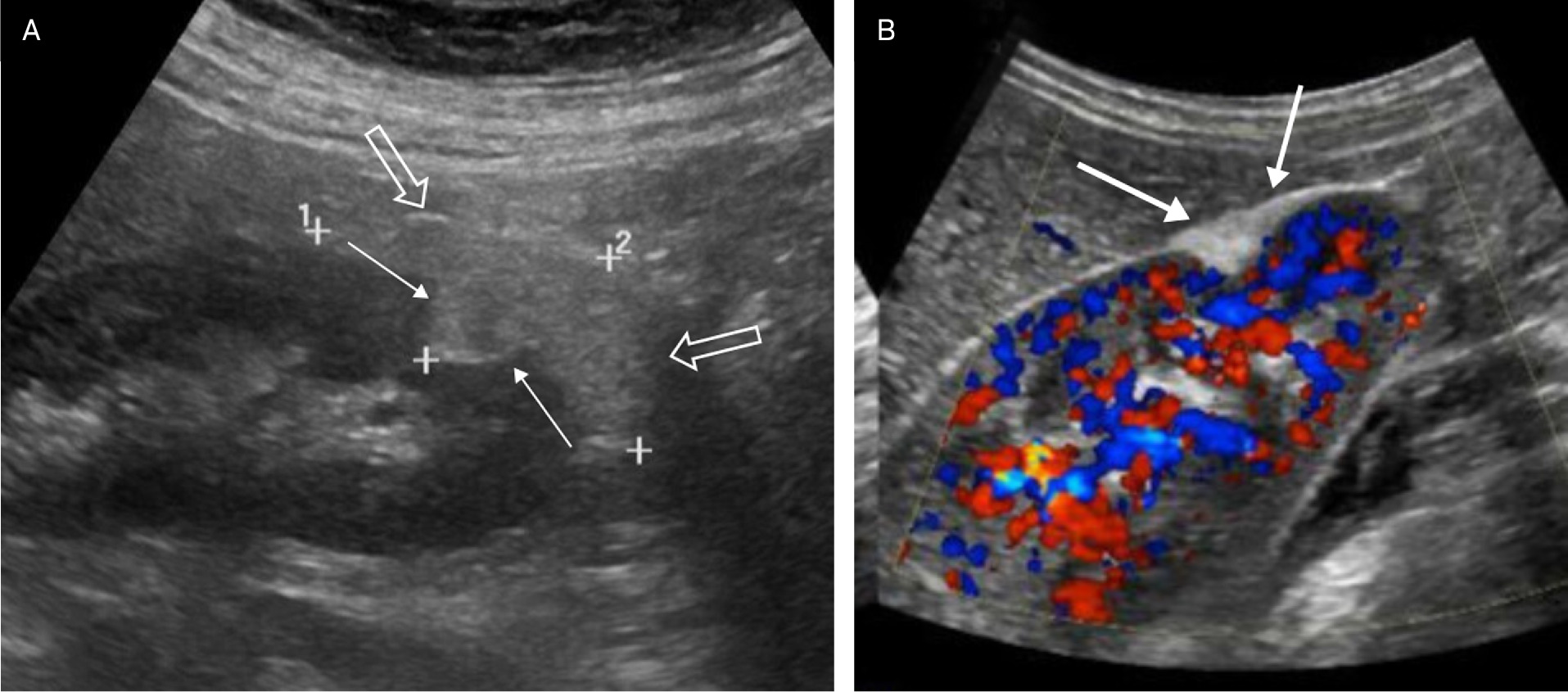 Renal US in an elderly patient with a large angiomyolipoma (AML) demonstrating an angular interface (solid arrows), but in addition the AML overflows the margins of the kidney as the “overflowing beer” sign (open arrows) (A). Renal color Doppler US image in an adult with peripheral AML demonstrating the “overflowing beer” sign (arrows) of the echogenic AML (B).