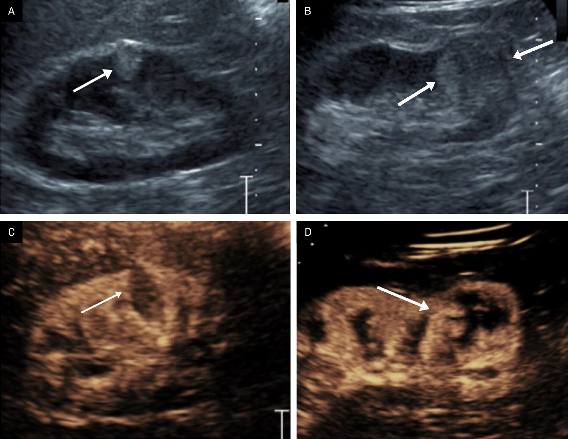 Benefit of contrast-enhanced US. Renal US demonstrating an echogenic interpolar renal mass with an angular interface, corresponding to an angiomyolipoma (AML) (arrow) (A). Renal US showing a more rounded, lower pole renal mass corresponding to a renal cell carcinoma (RCC) (arrows) (B). Contrast-enhanced US showing renal parenchymal enhancement, but little enhancement within the AML (arrow) (C). Contrast-enhanced US showing that the mass enhances as great or greater than the renal parenchyma, with a slightly enhancing rim, indicating an RCC (arrow) (D). Figure is courtesy of Richard G. Barr, MD, PhD, of Northeast Ohio Medical University.