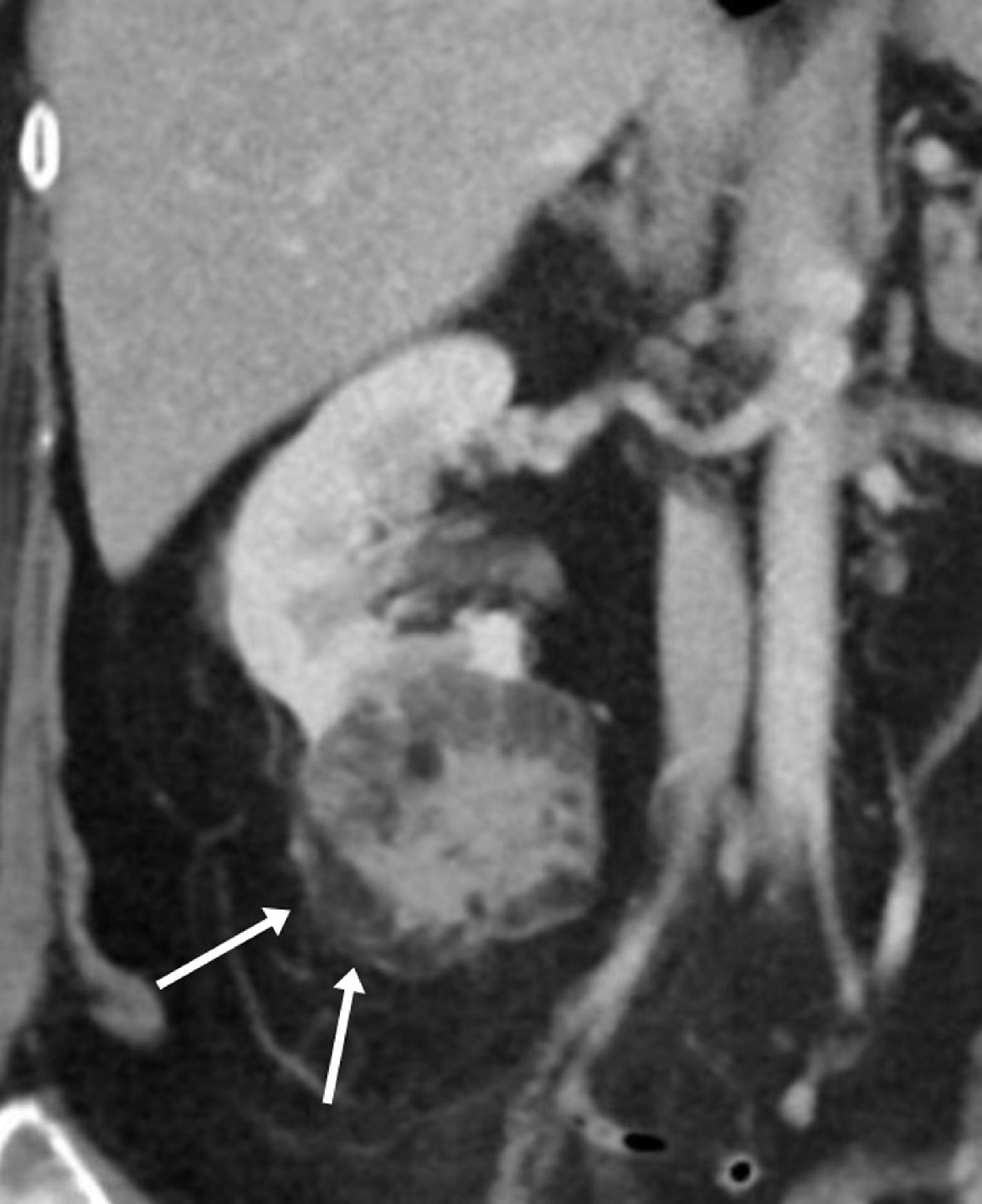 Coronal contrast-enhanced CT of the abdomen shows a right lower pole mass with solid components and macroscopic fat with Hounsfield units < 10 (arrows), consistent with a large, fat-rich angiomyolipoma.
