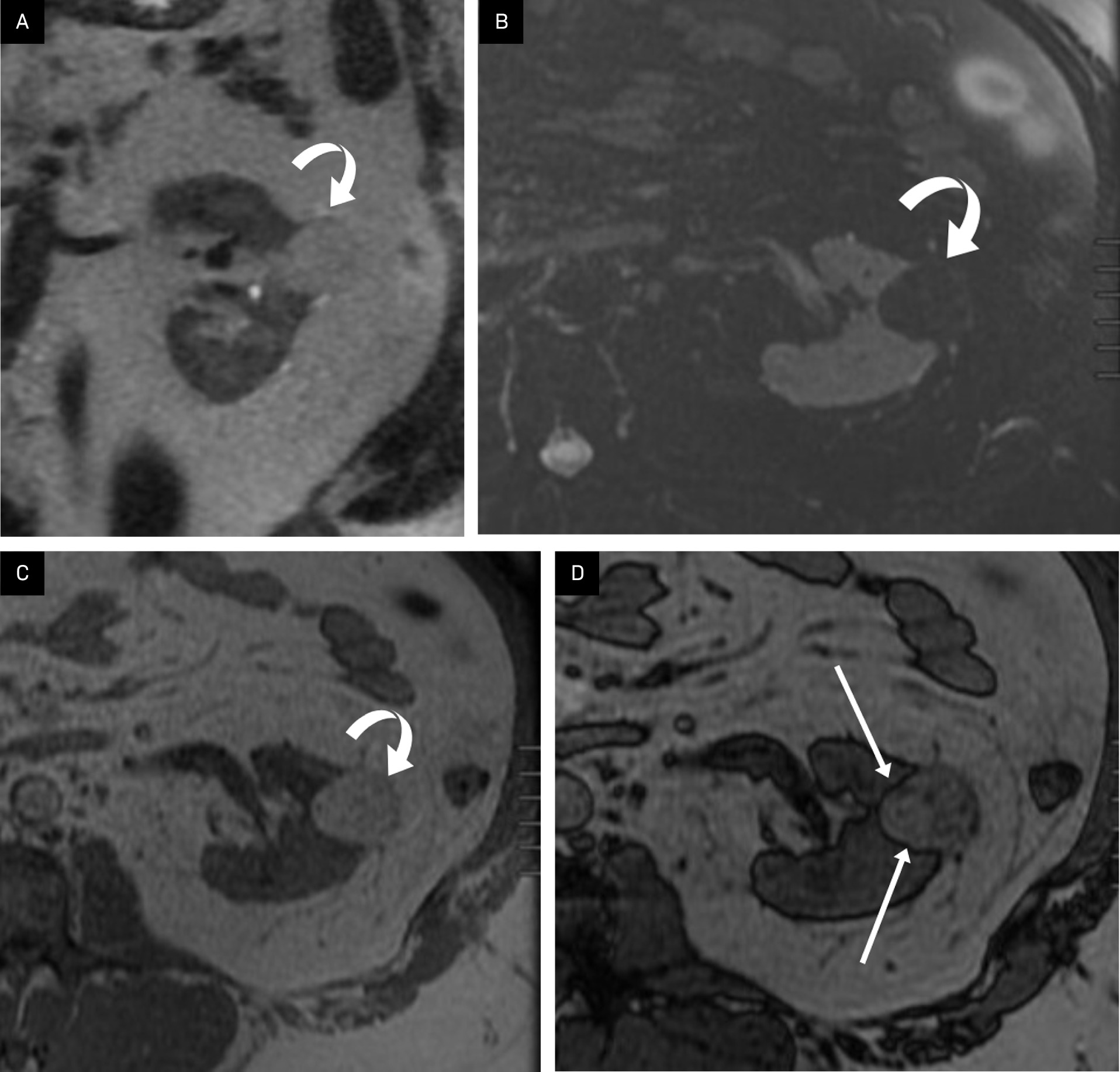 Classic angiomyolipoma (AML) on MRI. Coronal single-shot fast spin echo T2 image of a left renal peripheral AML (curved arrow), largely isointense to retroperitoneal fat (A). Axial T2 fat-suppressed image showing complete loss of signal intensity consistent with macroscopic fat in an AML (curved arrow) of the left kidney (B). Axial in-phase T1 MRI showing high signal intensity AML (curved arrow) in the left kidney (C). Axial out-of-phase MRI showing the “India ink” artifact as a dark line (arrows) at the interface of the macroscopic fat in the AML with the solid-appearing renal tissue (D).