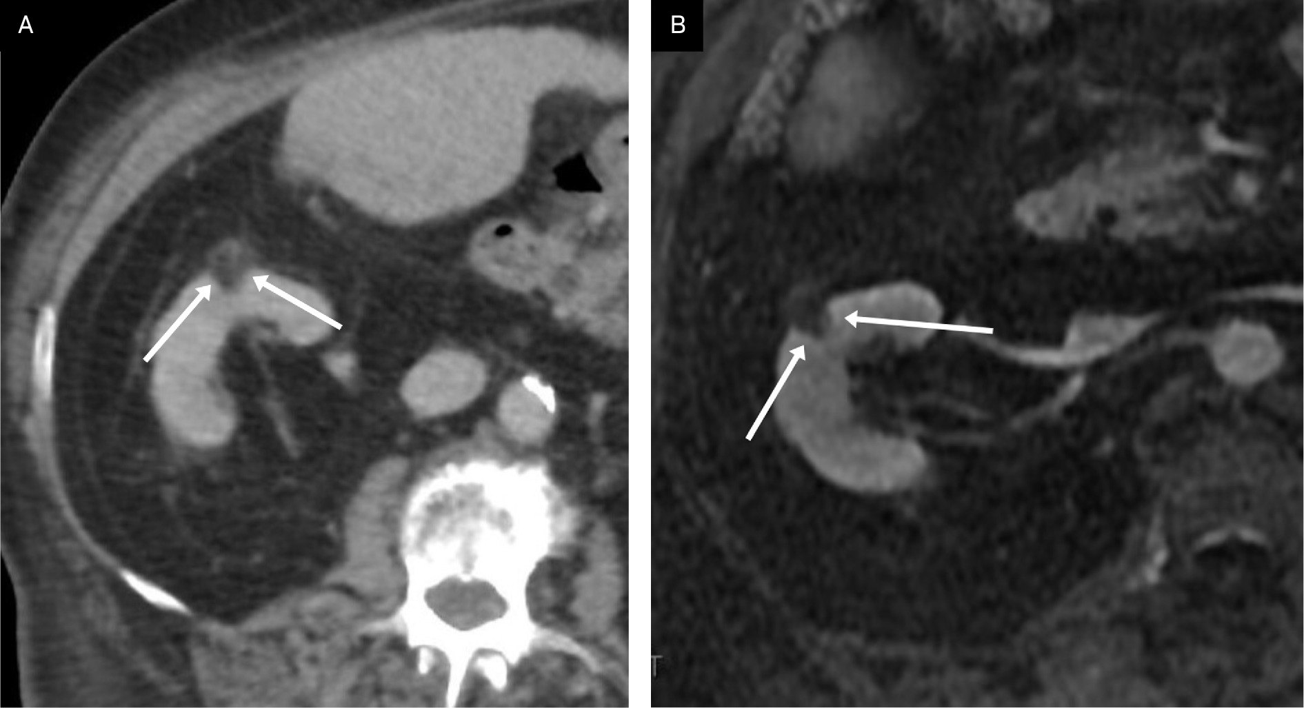 Angular interface on CT/MRI of angiomyolipoma (AML). An elderly patient with a peripheral AML on contrast-enhanced CT (A) and T1 LAVA post-contrast-enhanced MRI (B) showing angular interface (arrows).