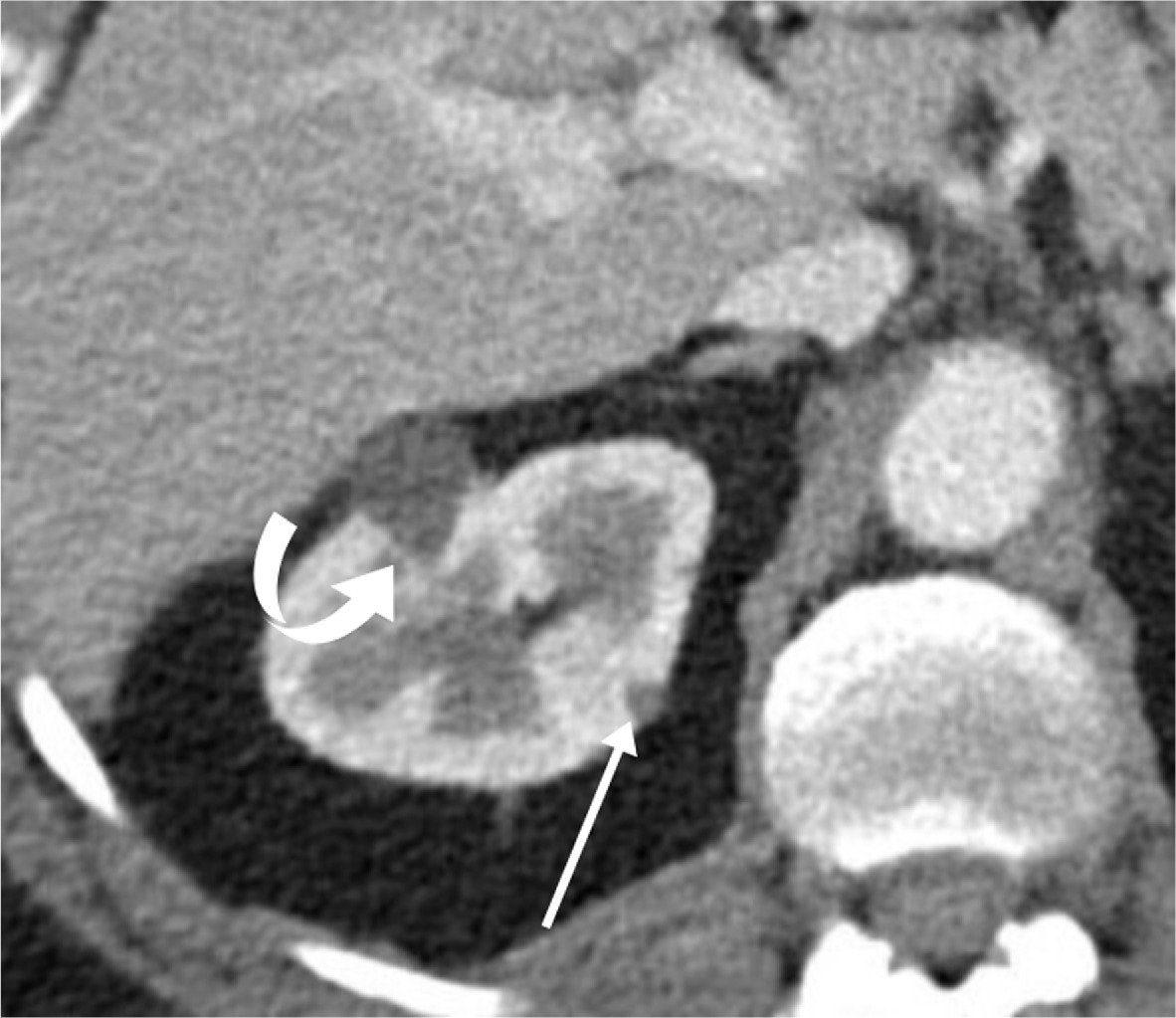 An elderly patient with a simple right renal cyst demonstrating an angular interface (curved arrow). Also note smaller peripheral hypodensity with an angular interface (arrow) probably representing an additional small cyst.