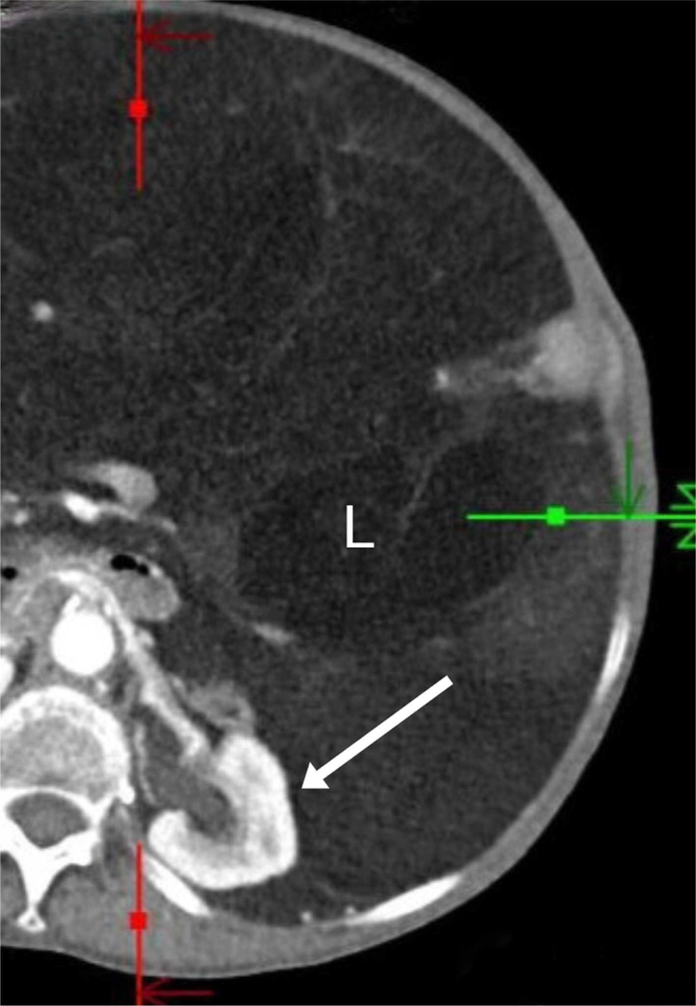 An elderly patient with a large retroperitoneal liposarcoma (L) that is poorly encapsulated and displaces the left kidney (arrow) without a capsular defect.