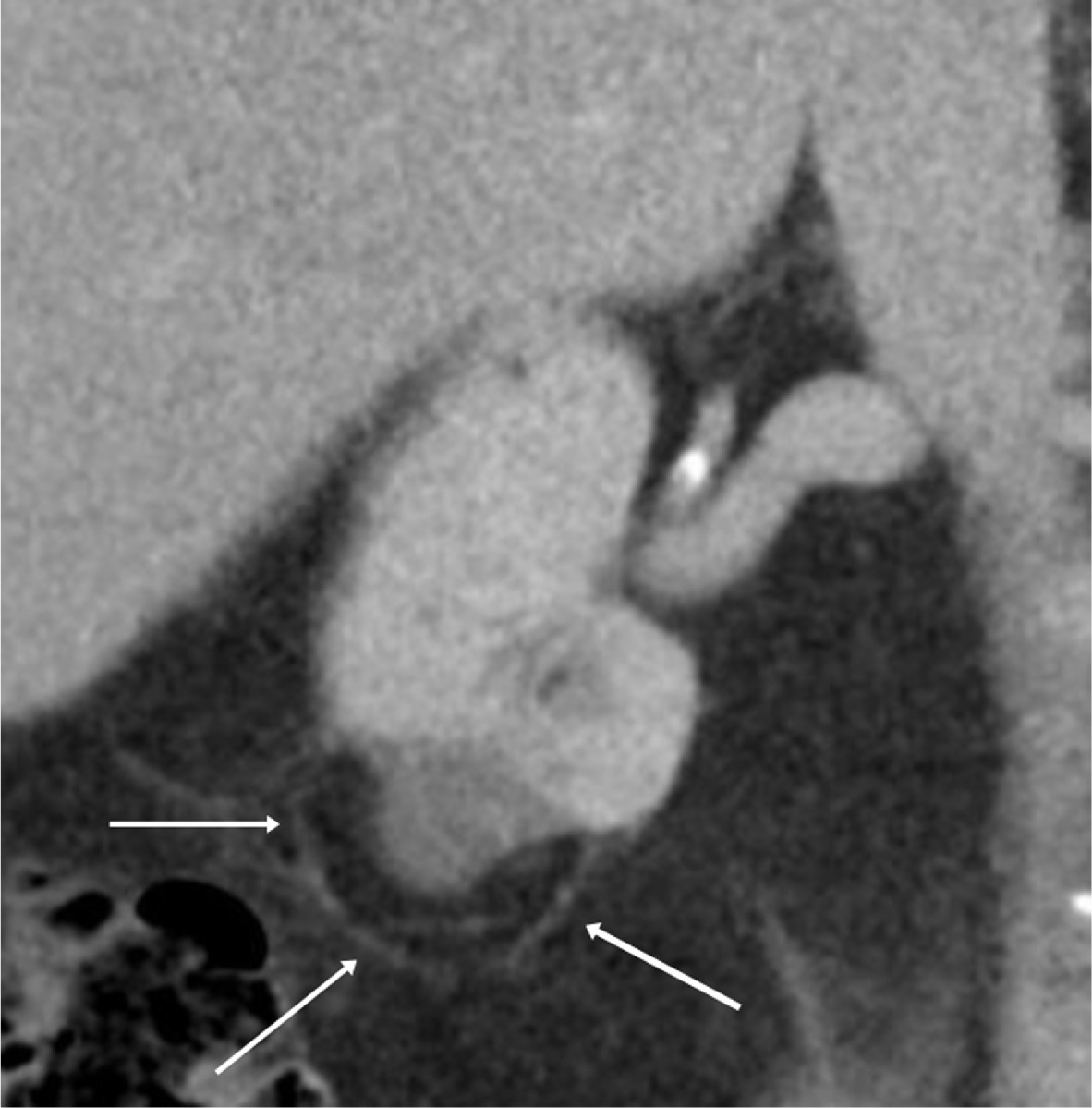 An elderly patient with a 1-year follow-up contrast-enhanced CT after radiofrequency ablation of a clear cell renal cell carcinoma, showing an avascular mass with surrounding encapsulated fat (arrows).