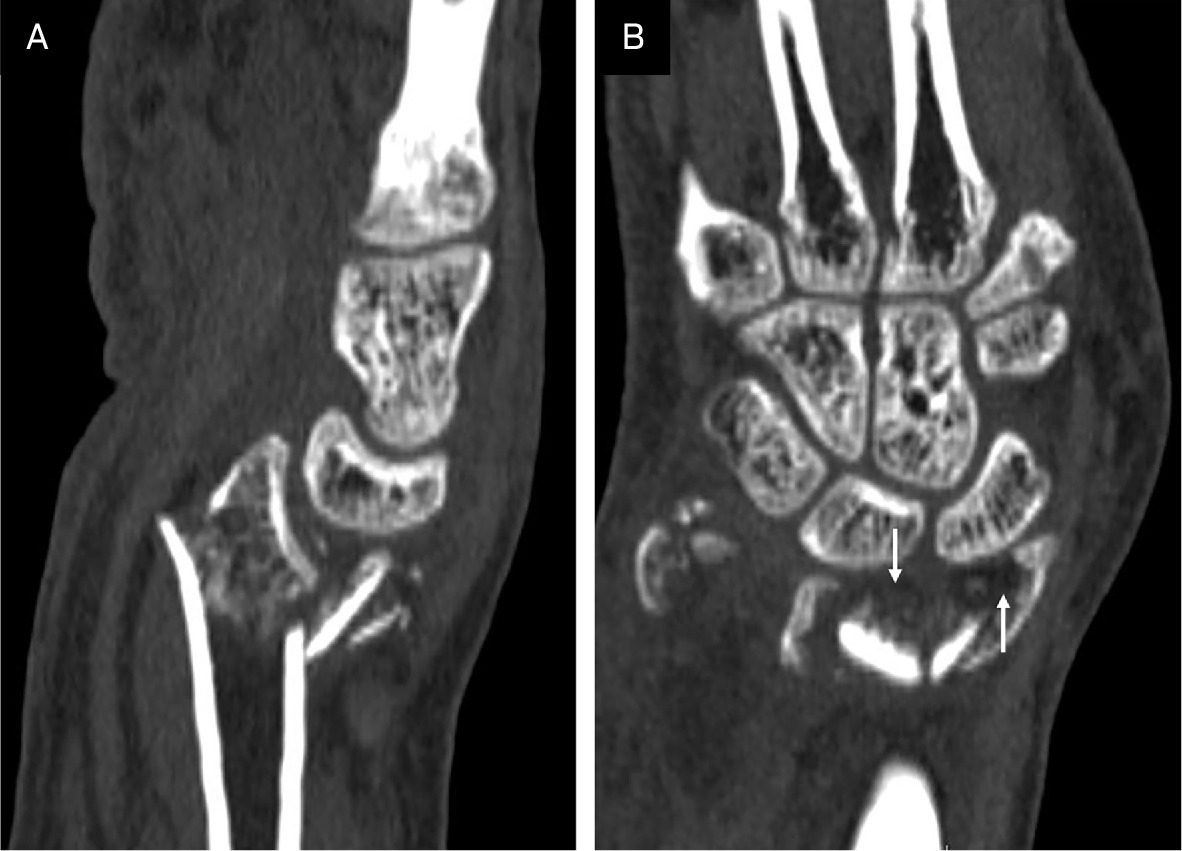 Sagittal and coronal reformatted CT images of the right wrist with bone reconstruction. Comminuted intra-articular fracture of the distal end of the radius is noted (A), while fat densities are noted in the wrist joint space (B, arrows).