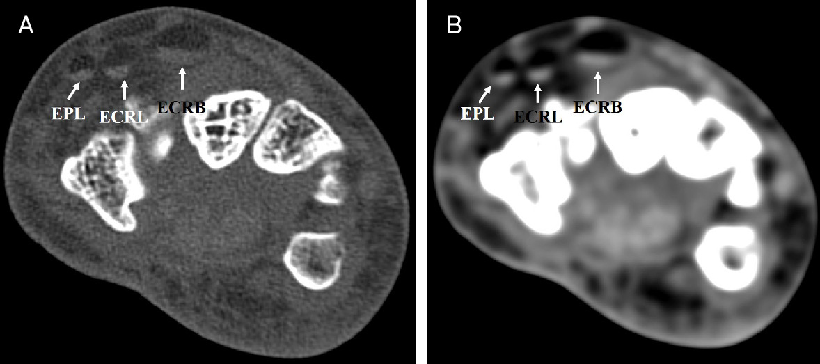 Axial CT images of the right wrist with bone reconstruction (A) and soft-tissue reconstruction (B). Fat-fluid levels are noted in the synovial sheaths of extensor pollicis longus (EPL), extensor carpi radialis longus (ECRL), and extensor carpi radialis brevis (ECRB) tendons.