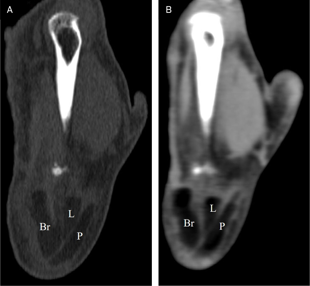 Coronal reformatted CT images of the right wrist with bone reconstruction (A) and soft-tissue reconstruction (B). Fat densities are noted in the synovial sheaths of extensor pollicis longus (P), extensor carpi radialis longus (L), and extensor carpi radialis brevis (Br) tendons.