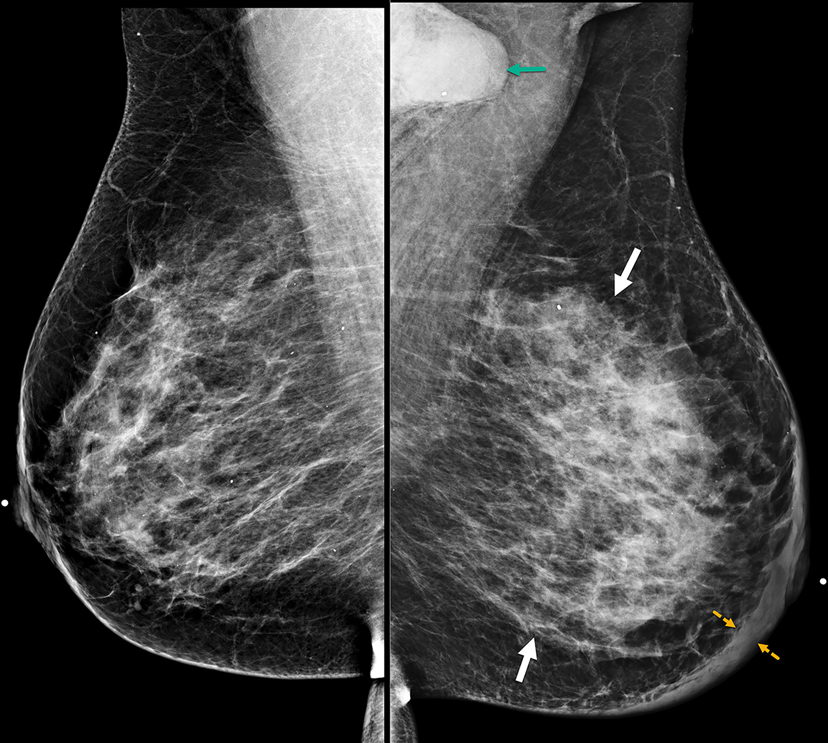 Bilateral mediolateral oblique digital mammogram at the diagnosis of the inflammatory breast cancer case demonstrates diffuse left breast enlargement, trabecular thickening (solid white arrows), and global skin thickening up to 9 mm (dashed yellow arrows). BI-RADS Category 5: highly suggestive of malignancy. Left axillary adenopathy is partially visible on mammogram (green arrow). Breast biopsy at the 12 o’clock position reveals triple-negative invasive ductal carcinoma and ductal carcinoma in situ. Biopsy of the left axillary node was positive for malignancy.