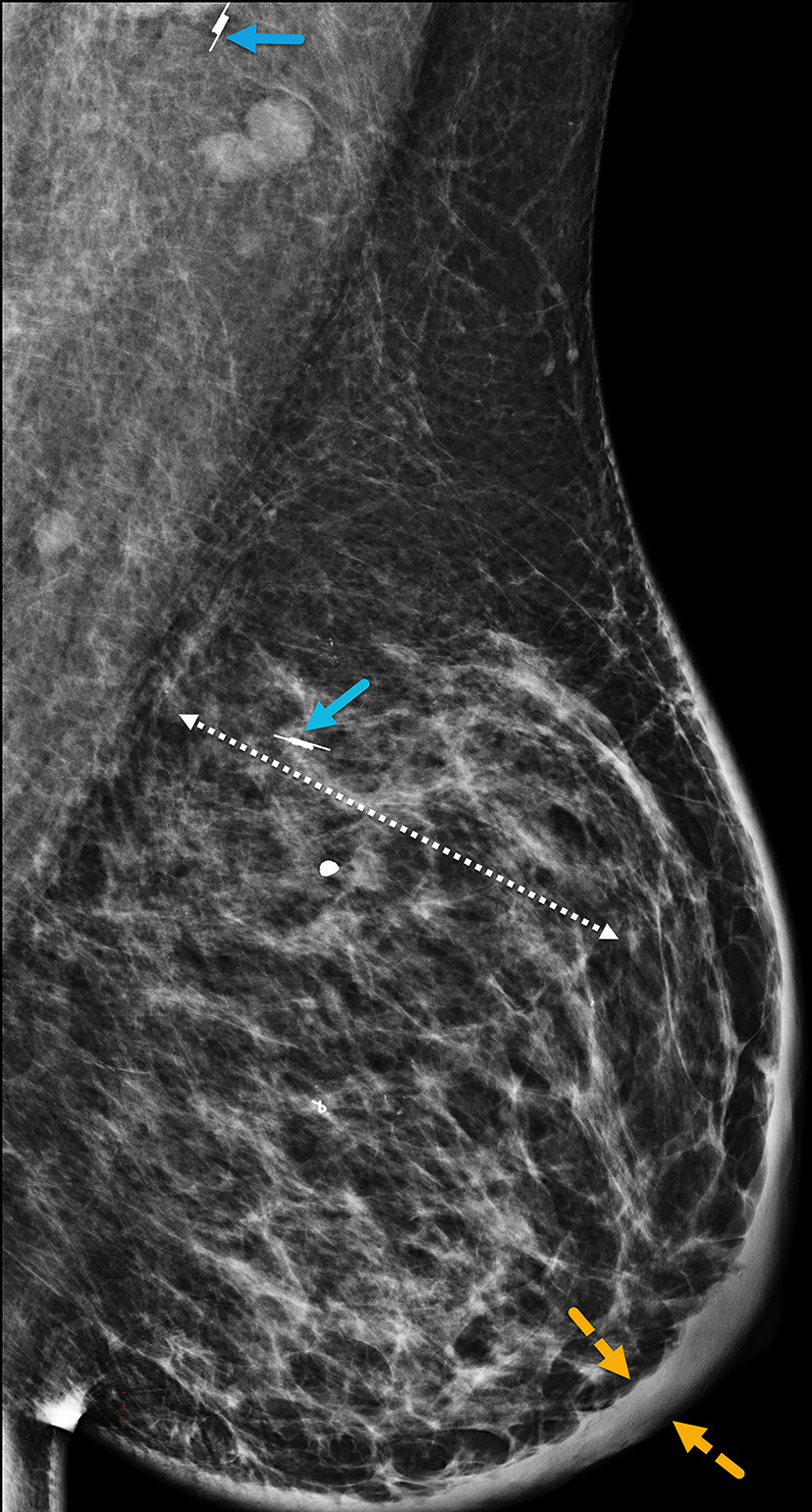 Mediolateral oblique left digital mammogram demonstrates diffuse skin thickening (solid yellow arrow) and suspicious, fine-linear pleomorphic calcifications (double-head dashed white arrow) spanning over 8.5 cm in the upper outer quadrant. BI-RADS Category 4C: suspicious for malignancy.