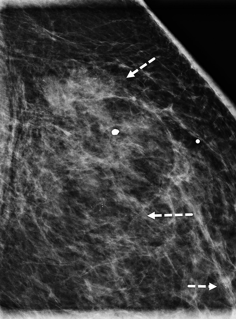Figure 2MLO magnification view of Figure 2 better visualizes the pleomorphic calcifications (dashed white arrows).