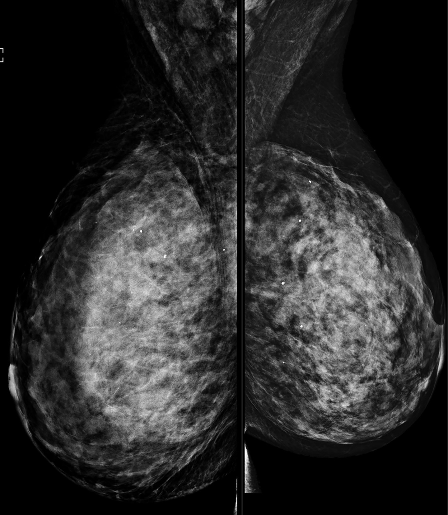 Mediolateral oblique view shows dense breast parenchyma, which obscures underlying masses. BI-RADS Category 0: incomplete, requires additional imaging evaluation.