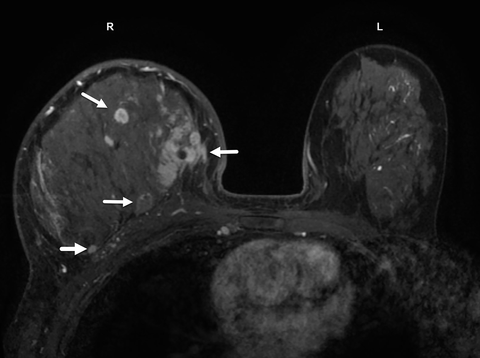 Axial postcontrast MRI of the same case as that in Figure 4 demonstrates multiple suspicious, enhancing masses (white arrows) throughout the dense right breast. Early phase dynamic MRI reveals tumoral enhancement from the delayed enhancement of background dense breast tissue. BI-RADS Category 5: highly suggestive of malignancy.