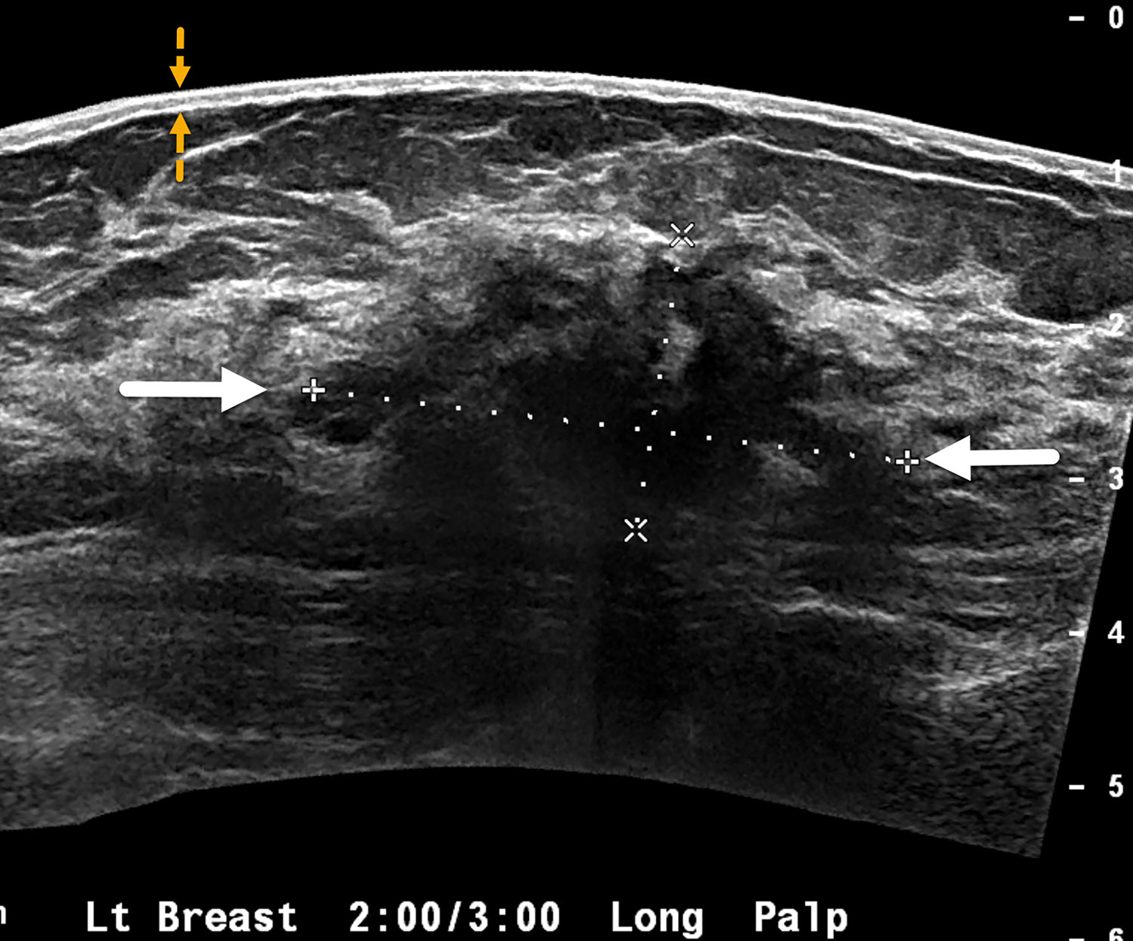 Sonogram of the left breast in a case of invasive ductal carcinoma shows a 4 cm mass with irregular margins and posterior acoustic shadowing (white arrows). BI-RADS Category 5: highly suggestive of malignancy. The skin is normal (yellow arrows), without thickening typically seen in inflammatory breast cancer.