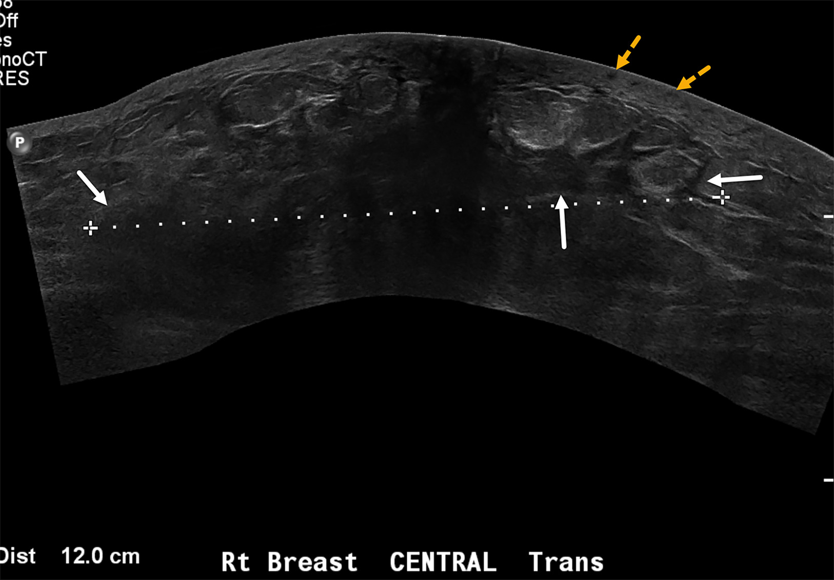 Wide FOV sonogram of the right breast in a case of newly diagnosed inflammatory breast cancer demonstrates ill-defined hypoechoic architectural distortion (solid white arrows) with diffuse posterior acoustic shadowing measuring 12 cm (dotted line). Unlike the case in Figure 6, diffuse tumoral infiltration of the entire right breast and skin thickening—but no discrete breast masses—were detected. The thickened skin contains tiny hypoechoic lesions (yellow dotted arrows) suggestive of dermal lymphatic involvement. BI-RADS Category 4C: high suspicion for malignancy.