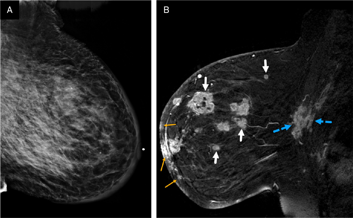 (A, B) Digital, mediolateral oblique mammogram in a senior patient with inflammatory breast cancer shows dense breast with no discrete mass. BI-RADS Category 0: needs additional imaging evaluation. Sagittal MR image of the same patient demonstrates multiple enhancing masses (solid white arrows) with irregular margins in multicentric distribution. Enhancing tumoral masses also extend into the anterior thickened skin (small yellow arrows) and infiltrate the chest wall (dotted blue arrows). BI-RADS Category 5: highly suggestive of malignancy.