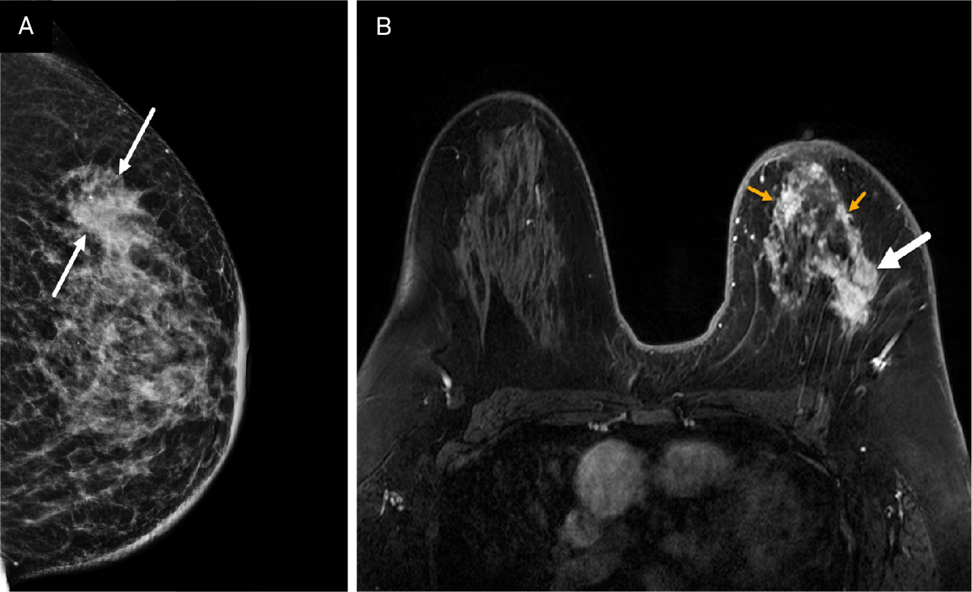 (A, B) Digital left craniocaudal mammogram demonstrates a mass in the lateral breast with irregular margins (solid white arrows) and mild medial skin thickening. BI-RADS Category 4C: high suspicion for malignancy. Axial postcontrast MRI of the same patient reveals additional tumoral lesions distributed multicentrically throughout the rest of the breast (small yellow arrows), along with the mass seen on mammogram (solid white arrow). Diffuse skin thickening is also observed of the left breast. BI-RADS Category 5: highly suggestive of malignancy. The multicentric disease is more conspicuous on the MRI than on the mammogram.